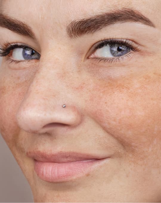 Pigmentation treatment at The One Clinic Leicester