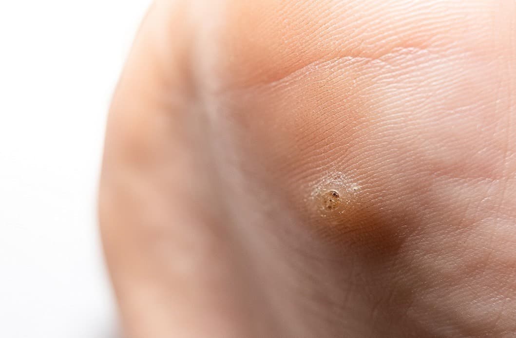 Stages Of A Wart Falling Off: What to Expect as It Heals