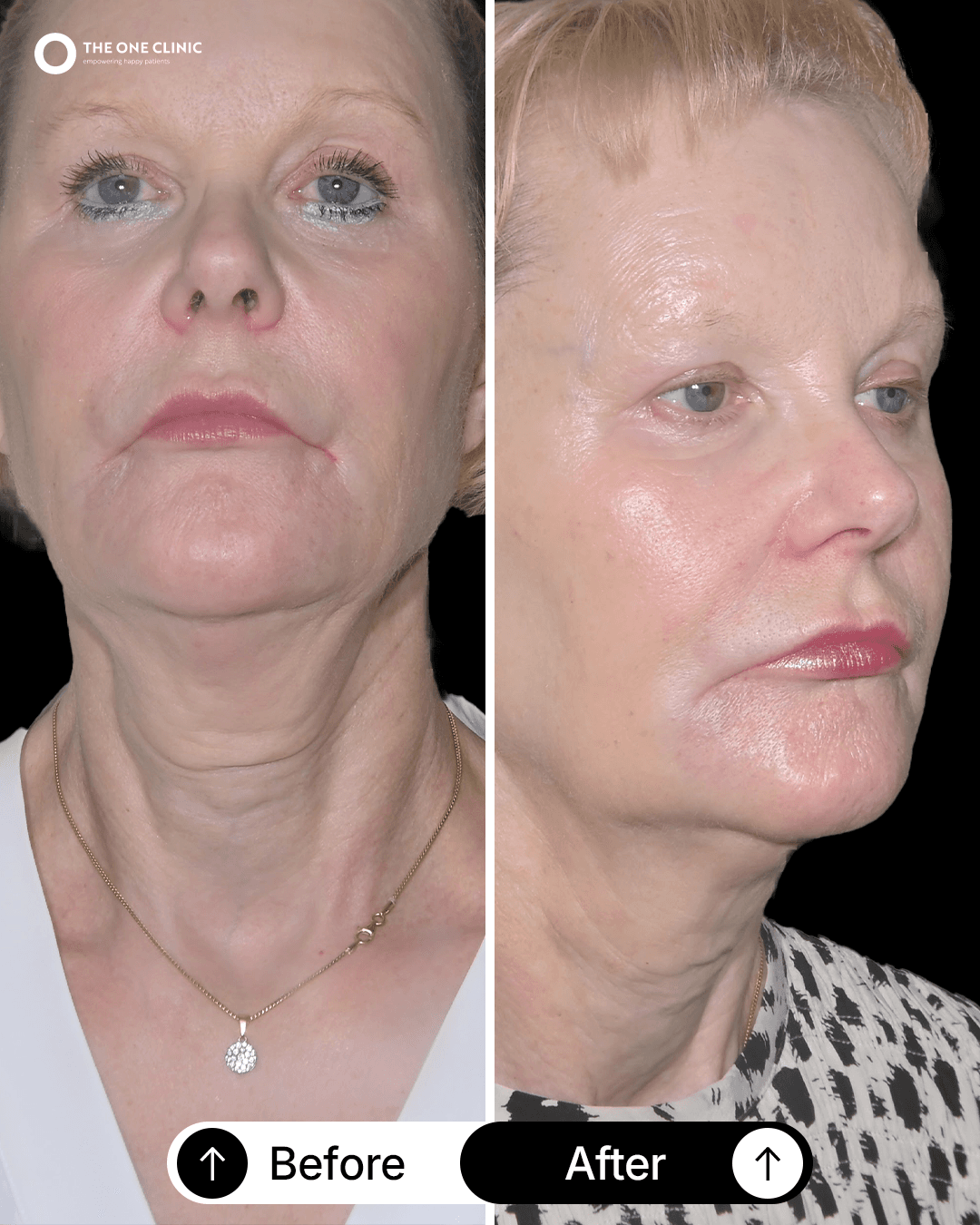 Patient before and after results
