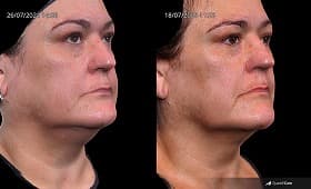 Exosome therapy skin rejuvenation result 1