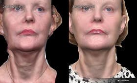 Exosome therapy skin rejuvenation result 2