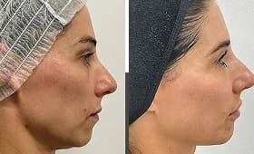 Exosome therapy skin rejuvenation result 3