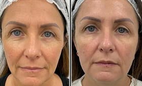 Endolift before and after result 4