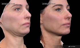 Exosome therapy skin rejuvenation result 5