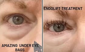 Exosome therapy skin rejuvenation result 6