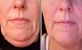 Endolift before and after result 7