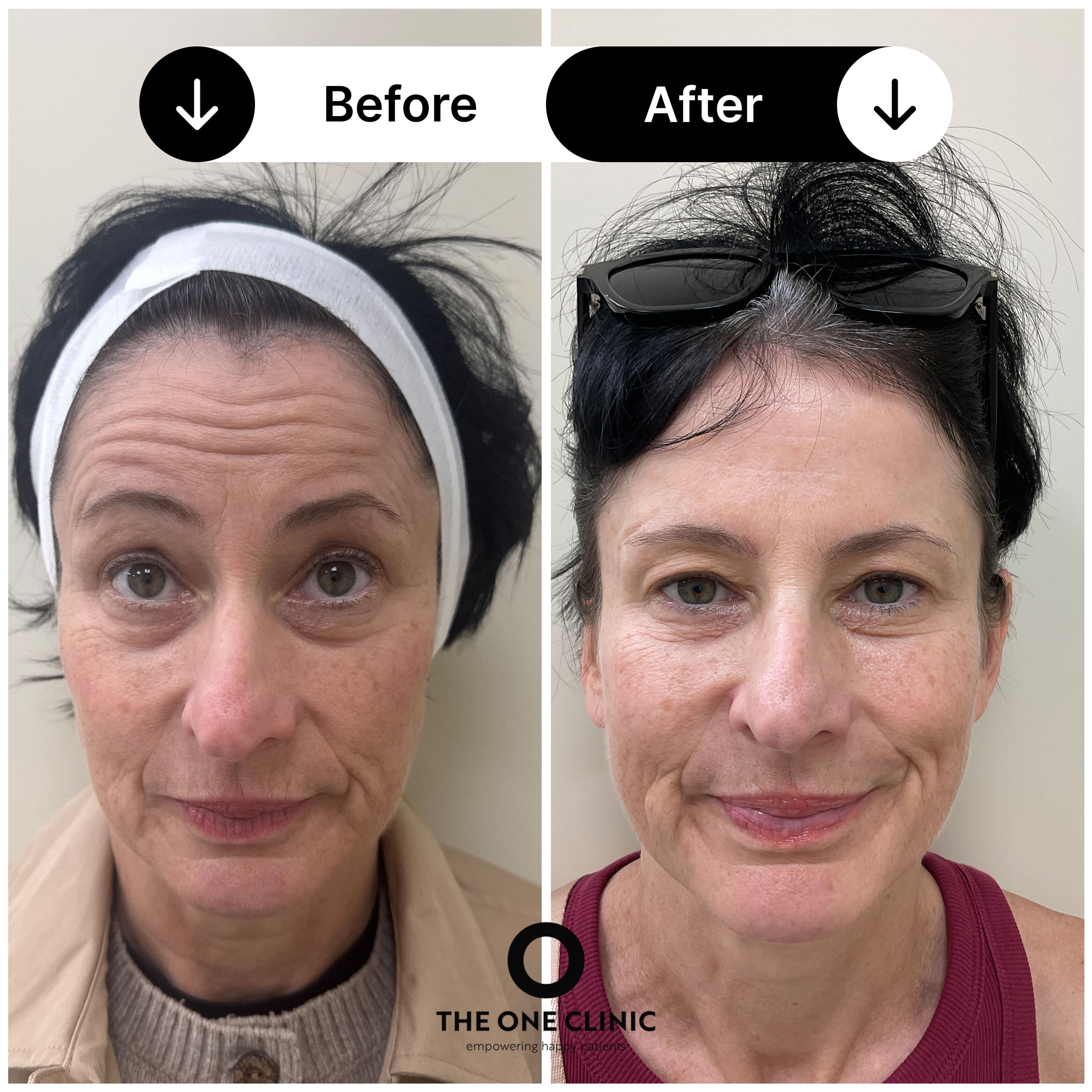 Anti-wrinkle injections before and after results