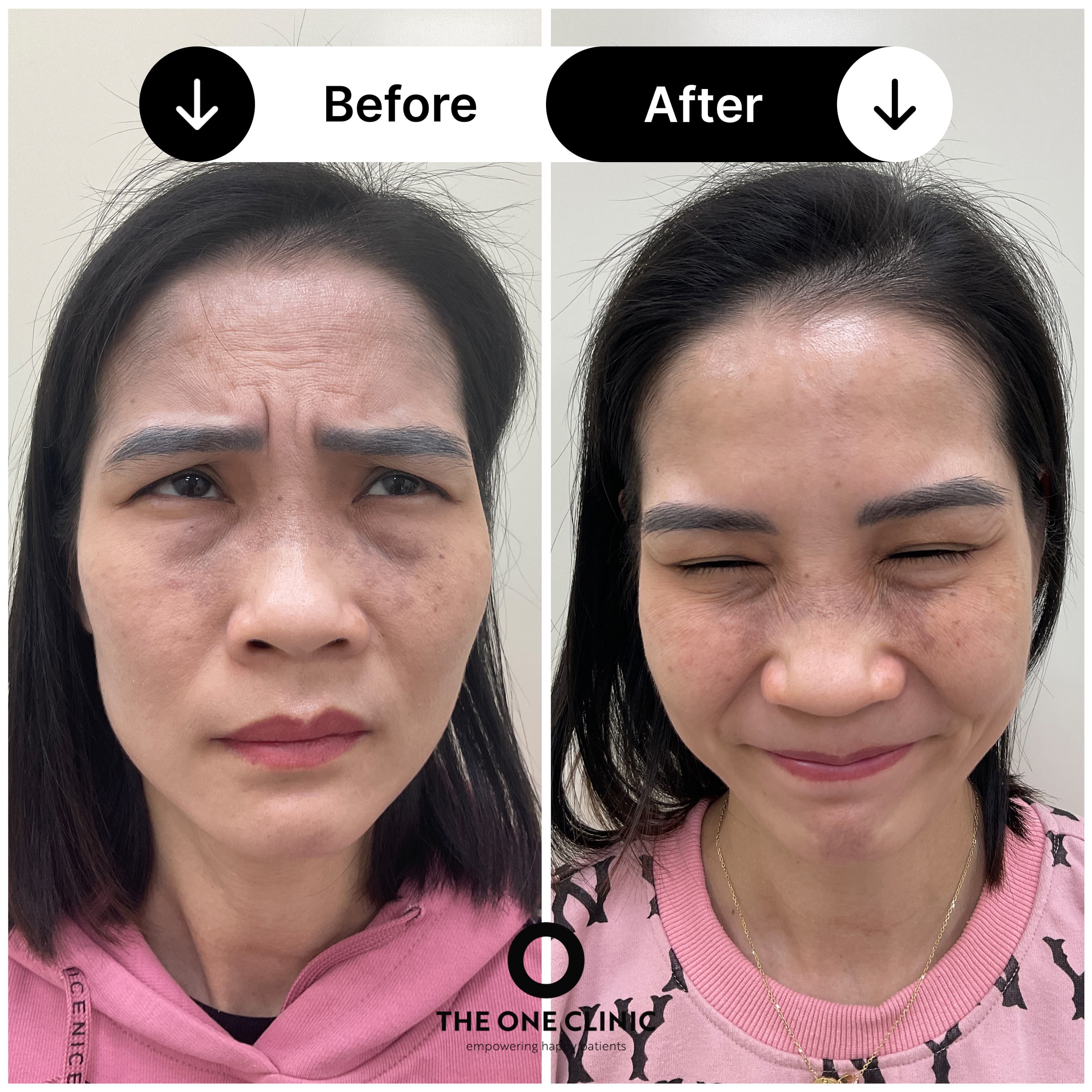 Anti-wrinkle injections before and after results