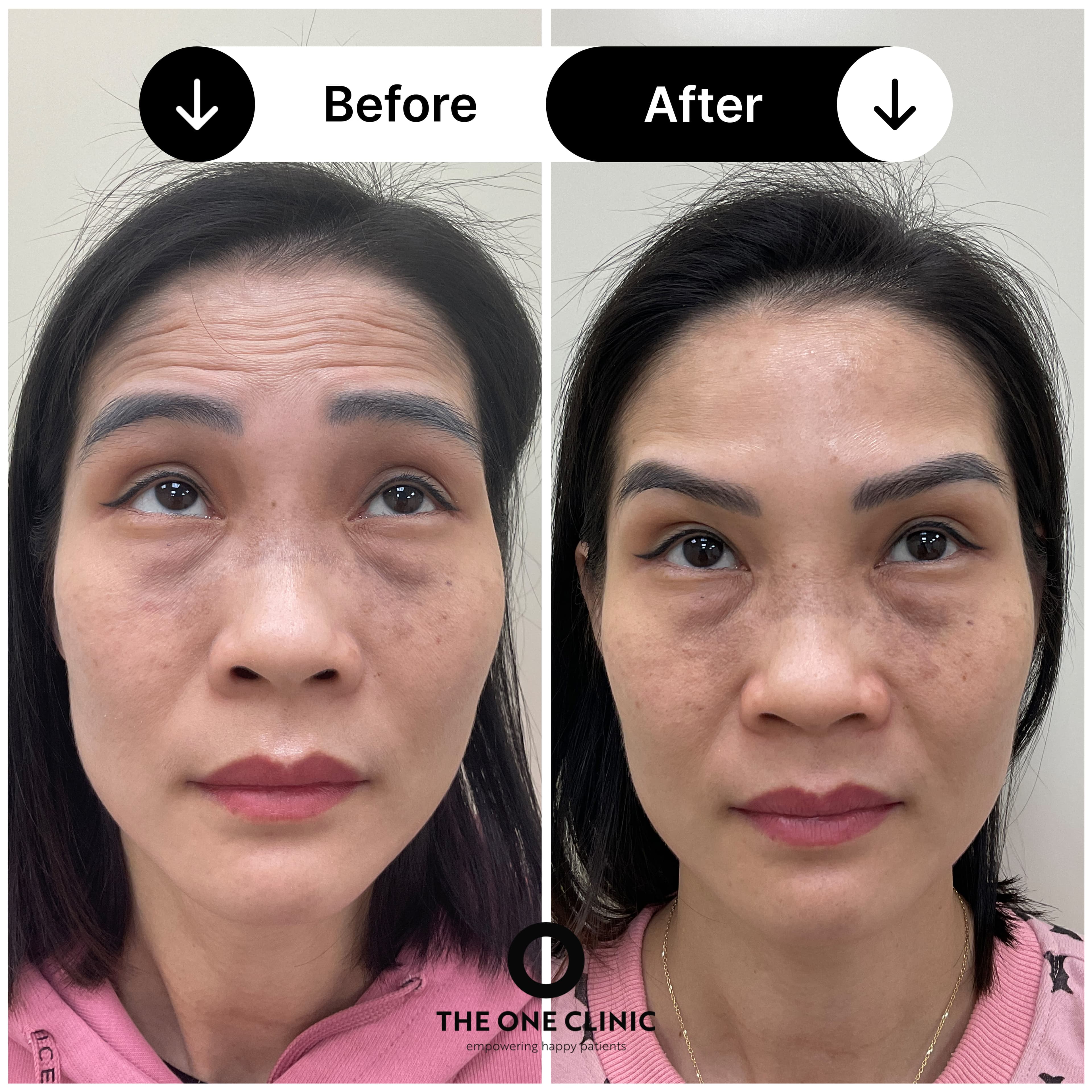Anti-wrinkle injections before and after results