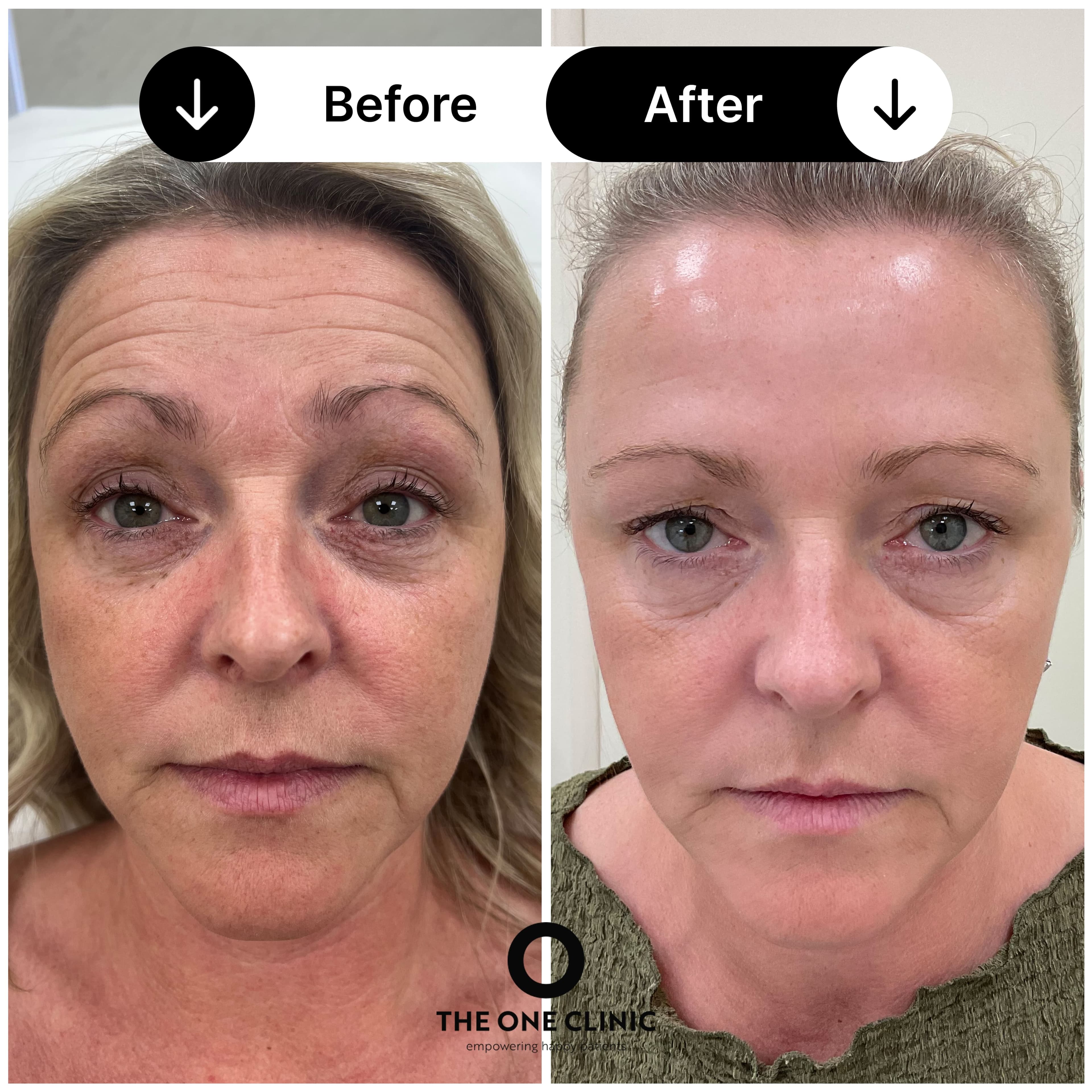Anti-wrinkle injections before and after results