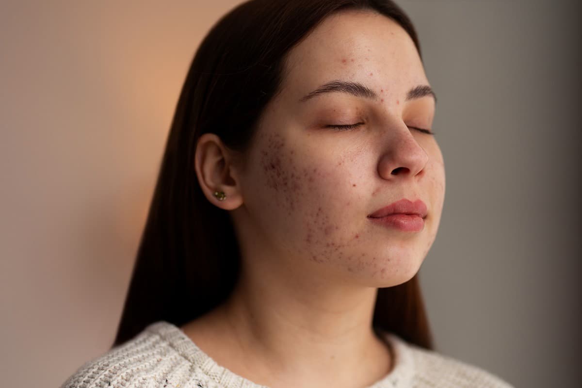 Best Treatment for Brown Spots on Face: Complete Guide