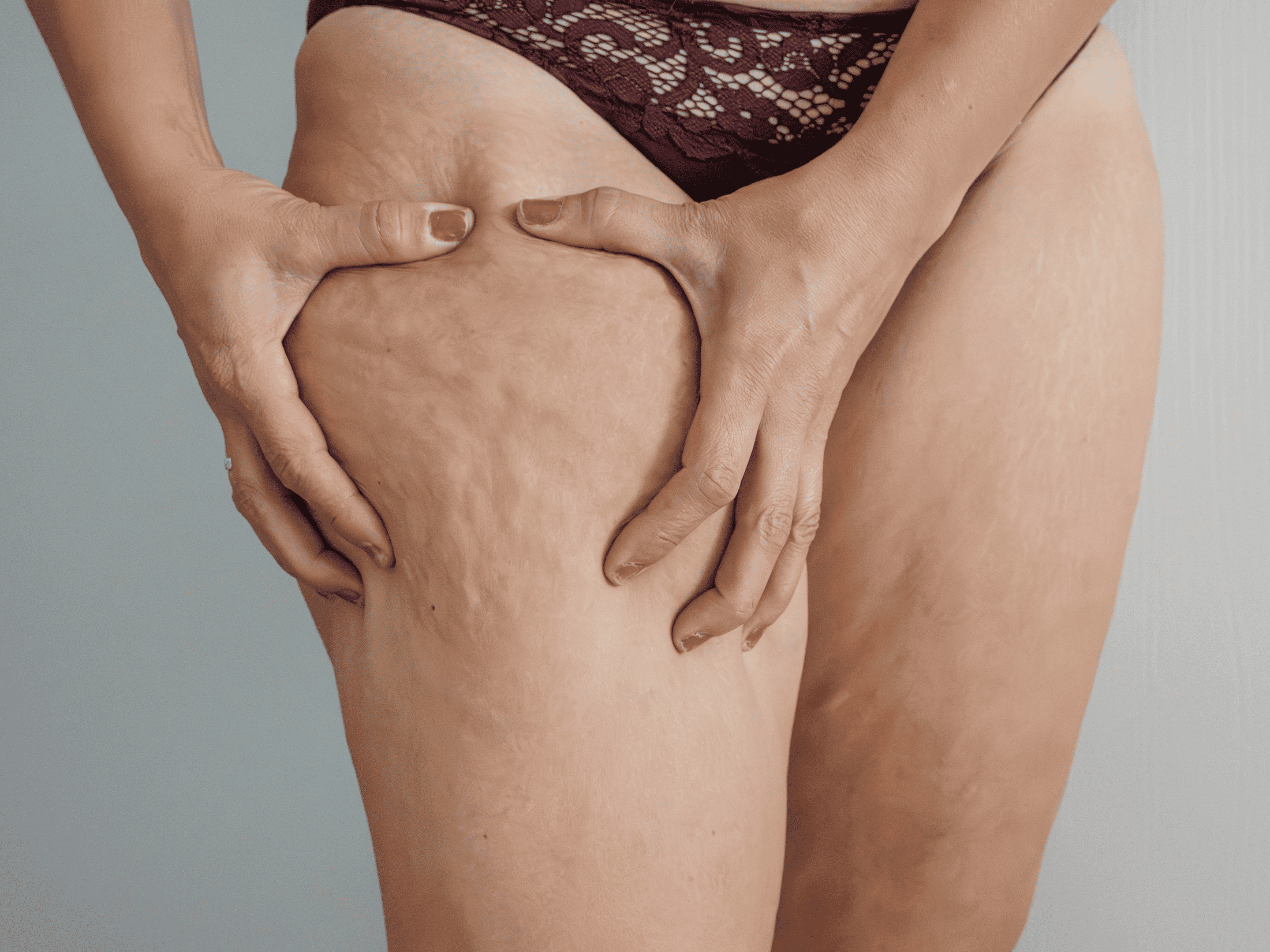 Cellulite treatment at The One Clinic Leicester , smooth and firm skin results
