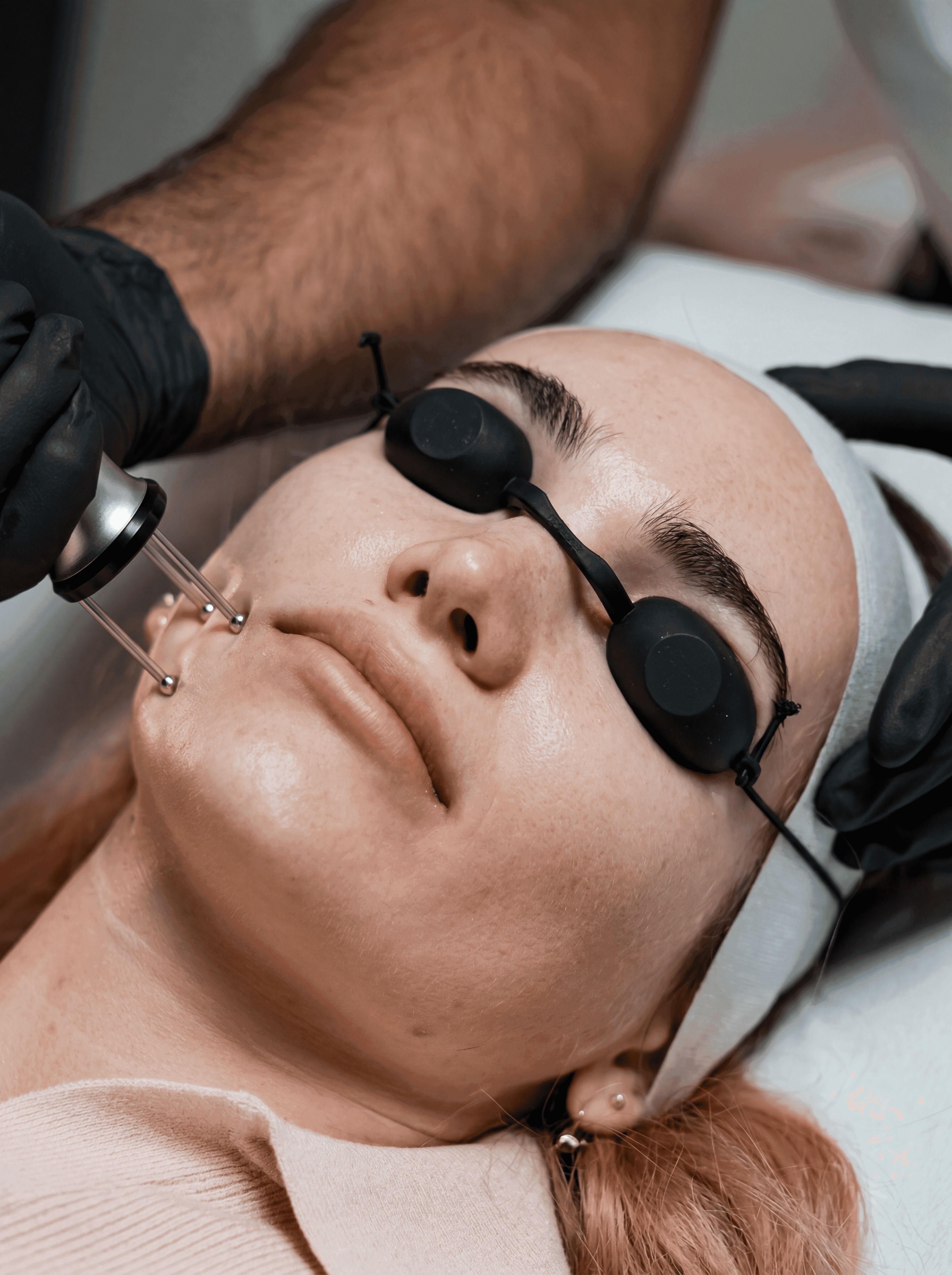 Deep laser resurfacing treatment at The One Clinic Leicester