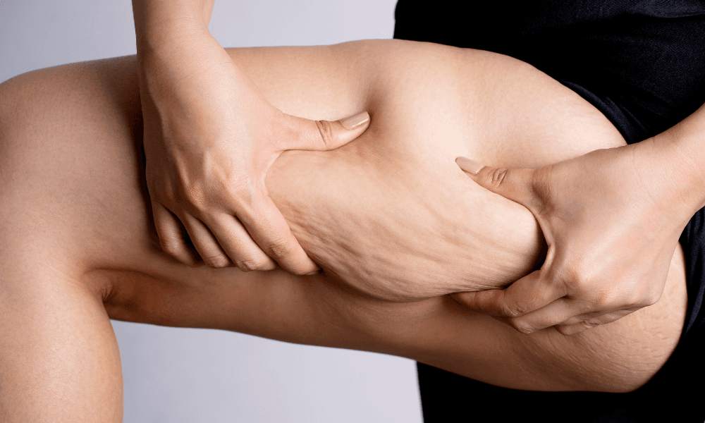 Does Liposuction Work? Results, Safety & What to Expect