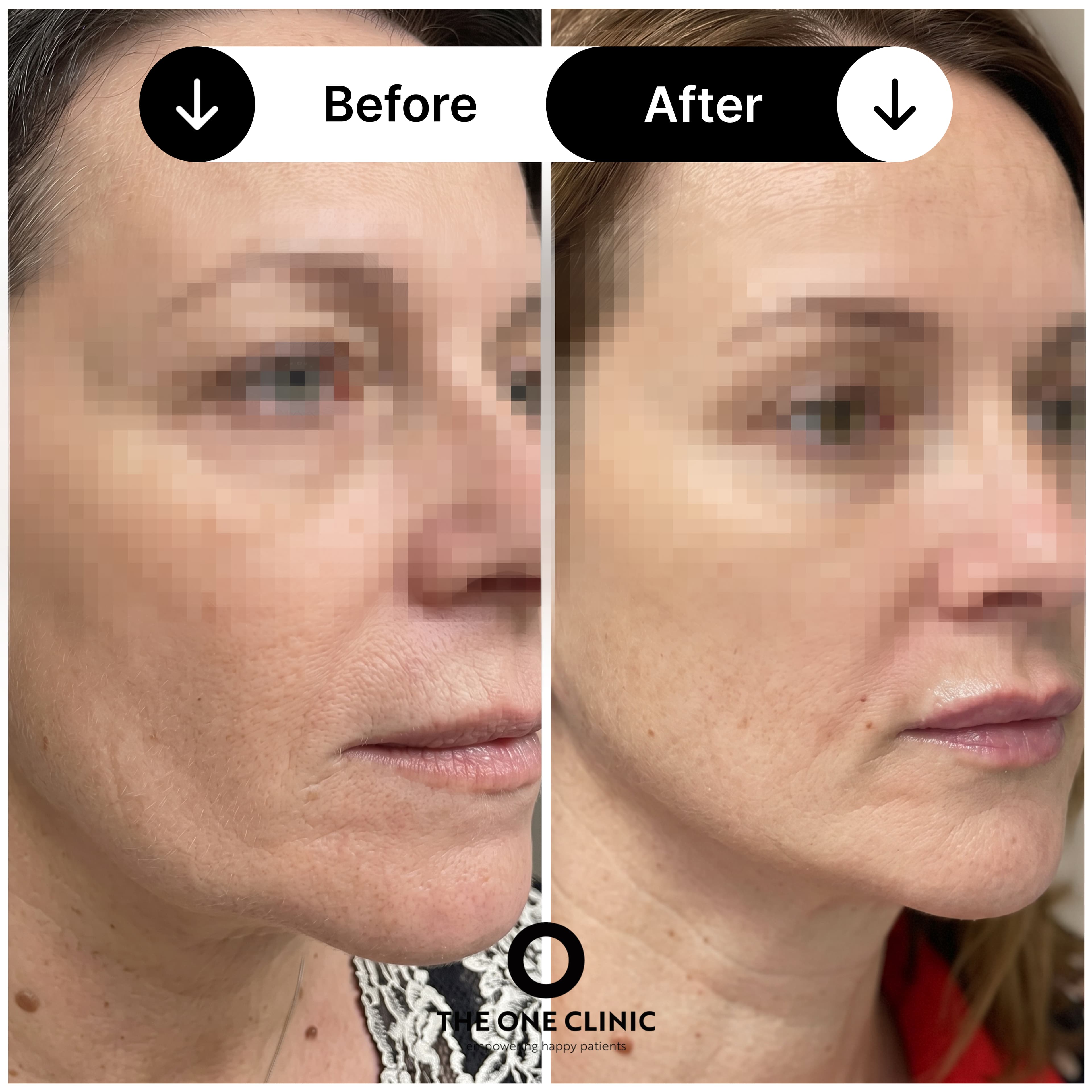 Endolift before and after result 1