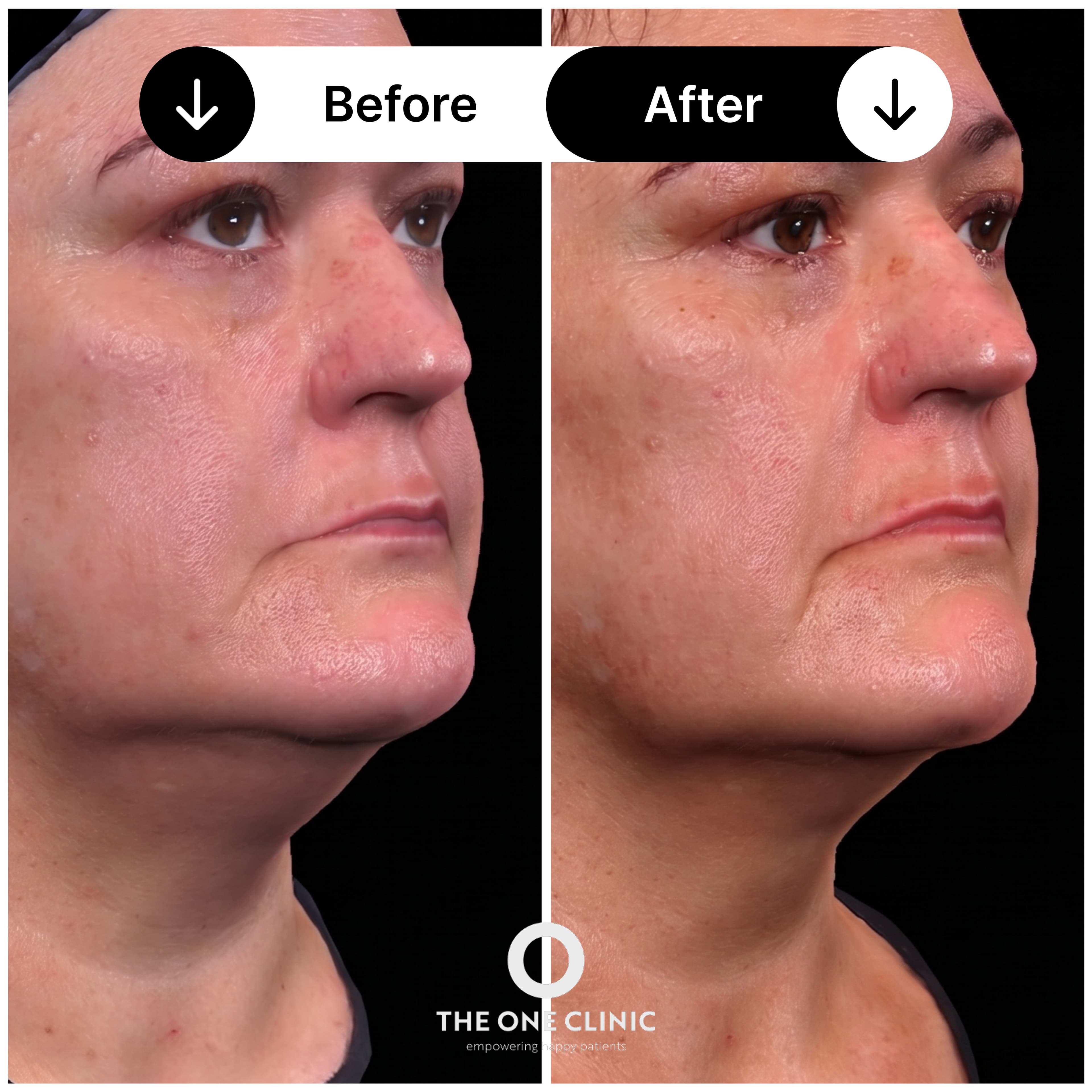 Endolift before and after result 4