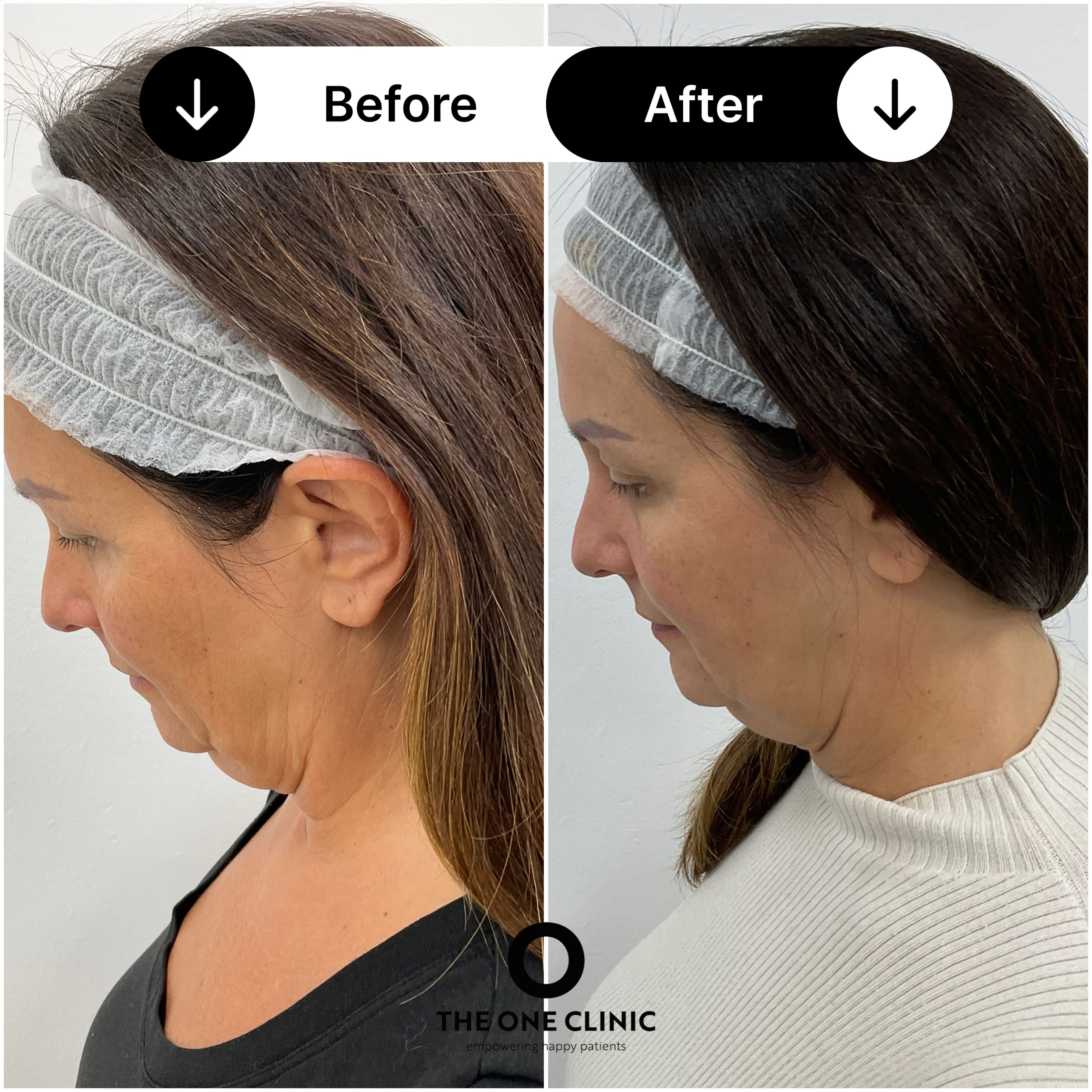 Endolift before and after result