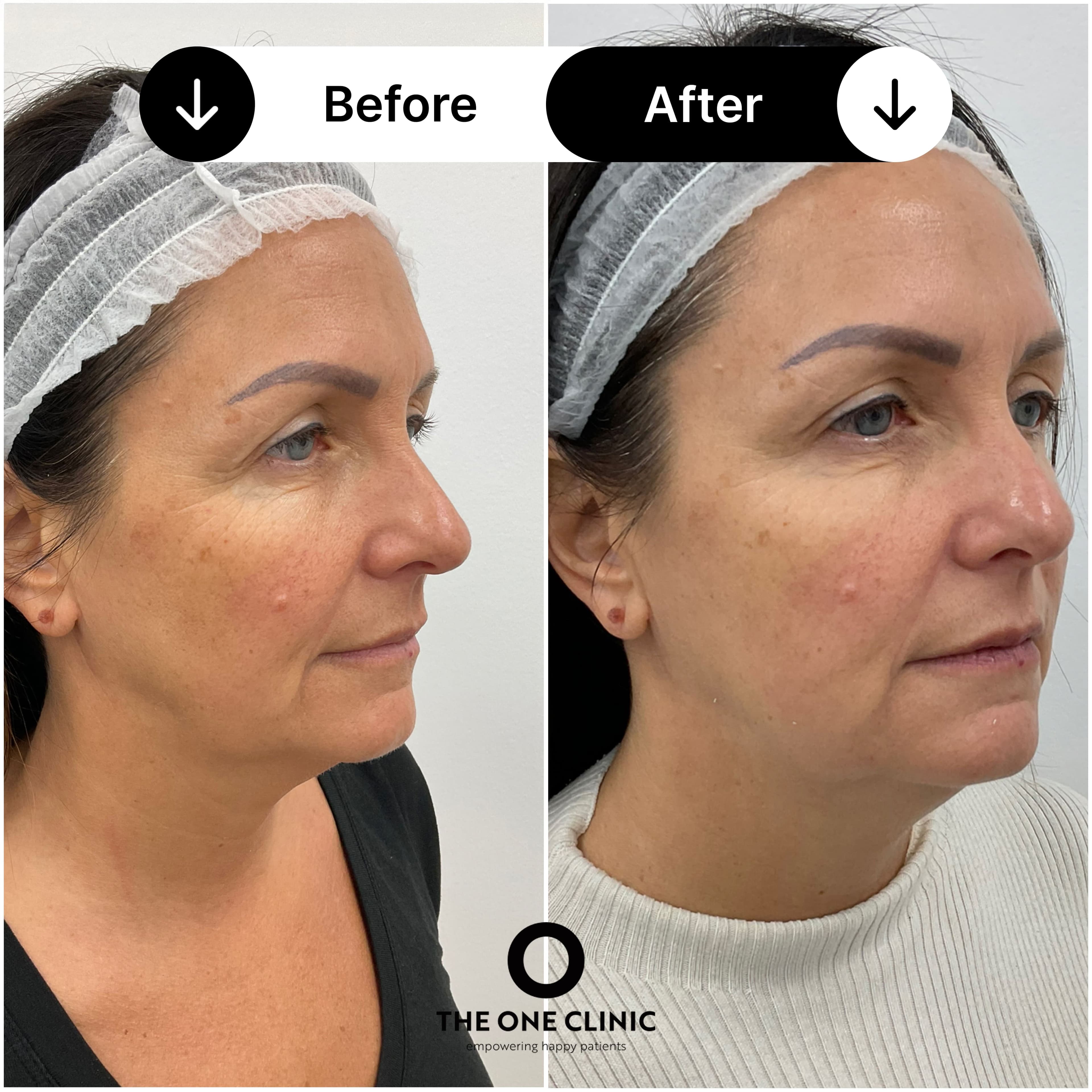 Endolift before and after result