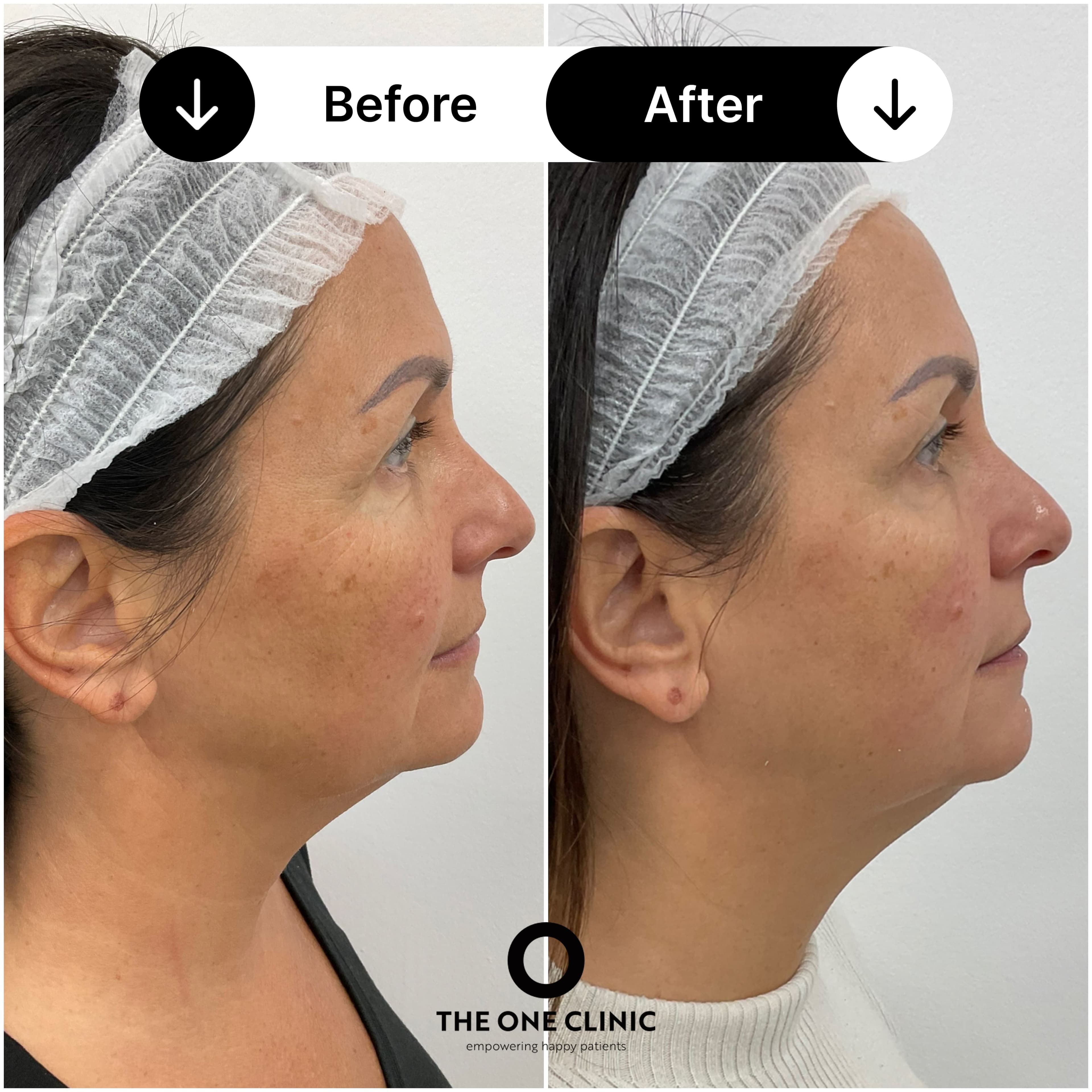 Endolift before and after result