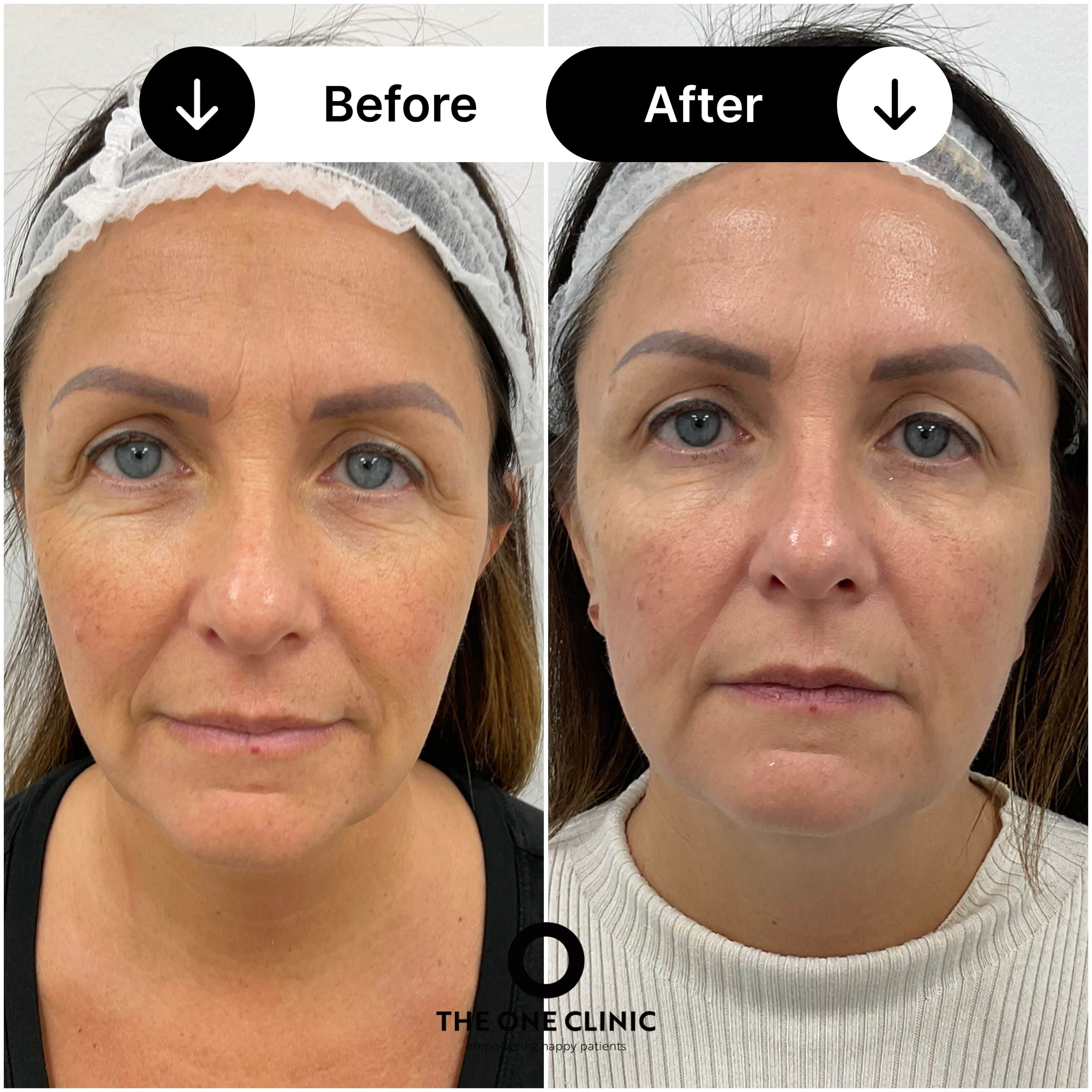 Endolift before and after result