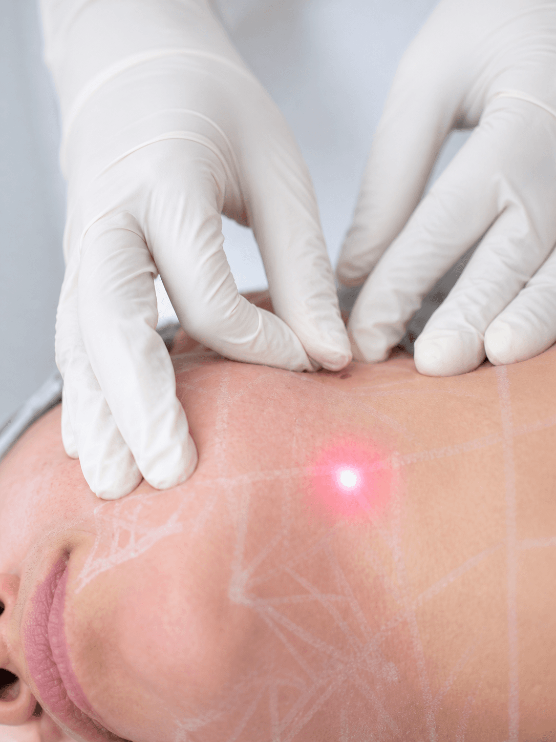 Endolift