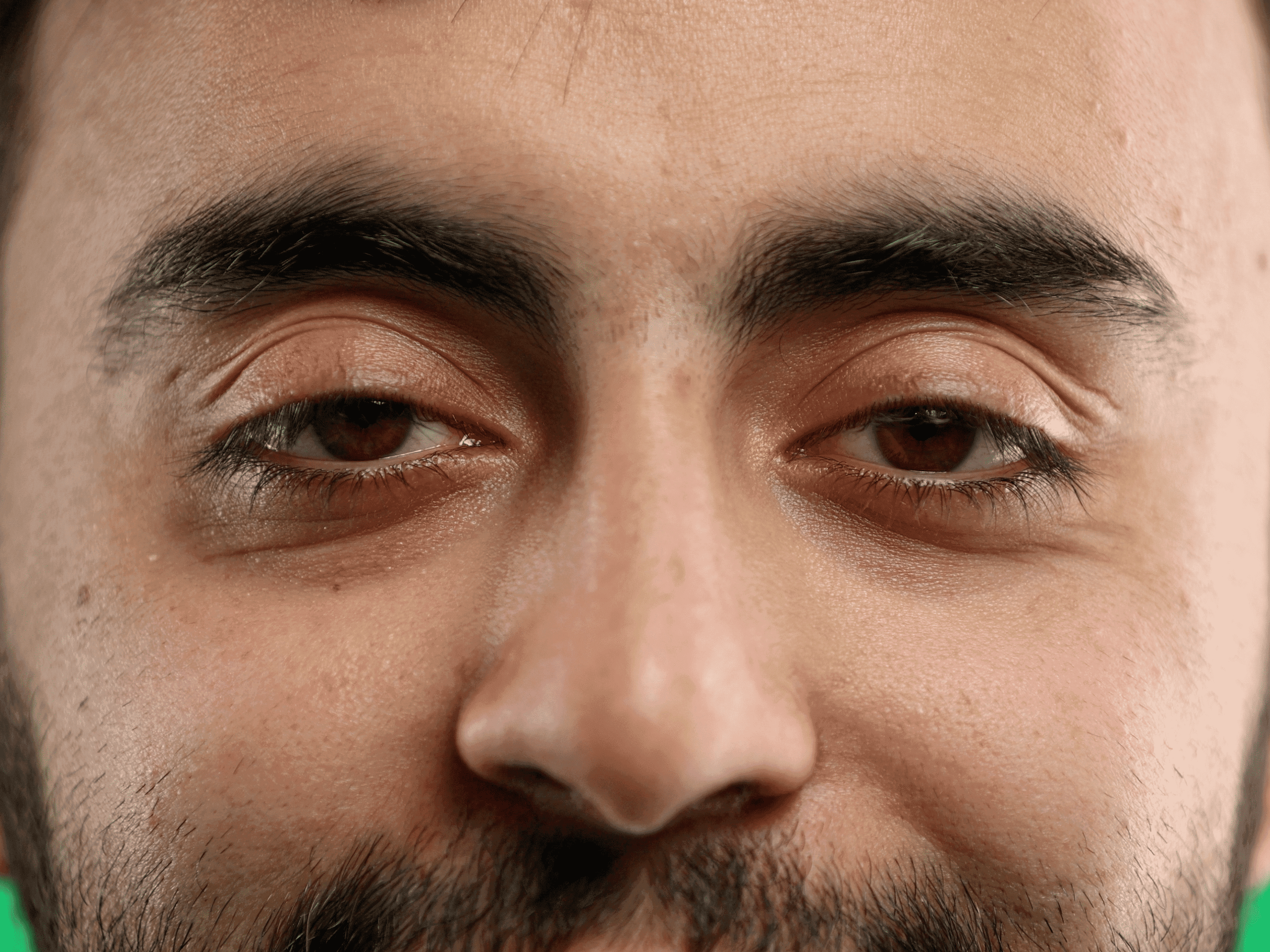 Close-up of under-eye area showing eye bags, treated at The One Clinic Leicester