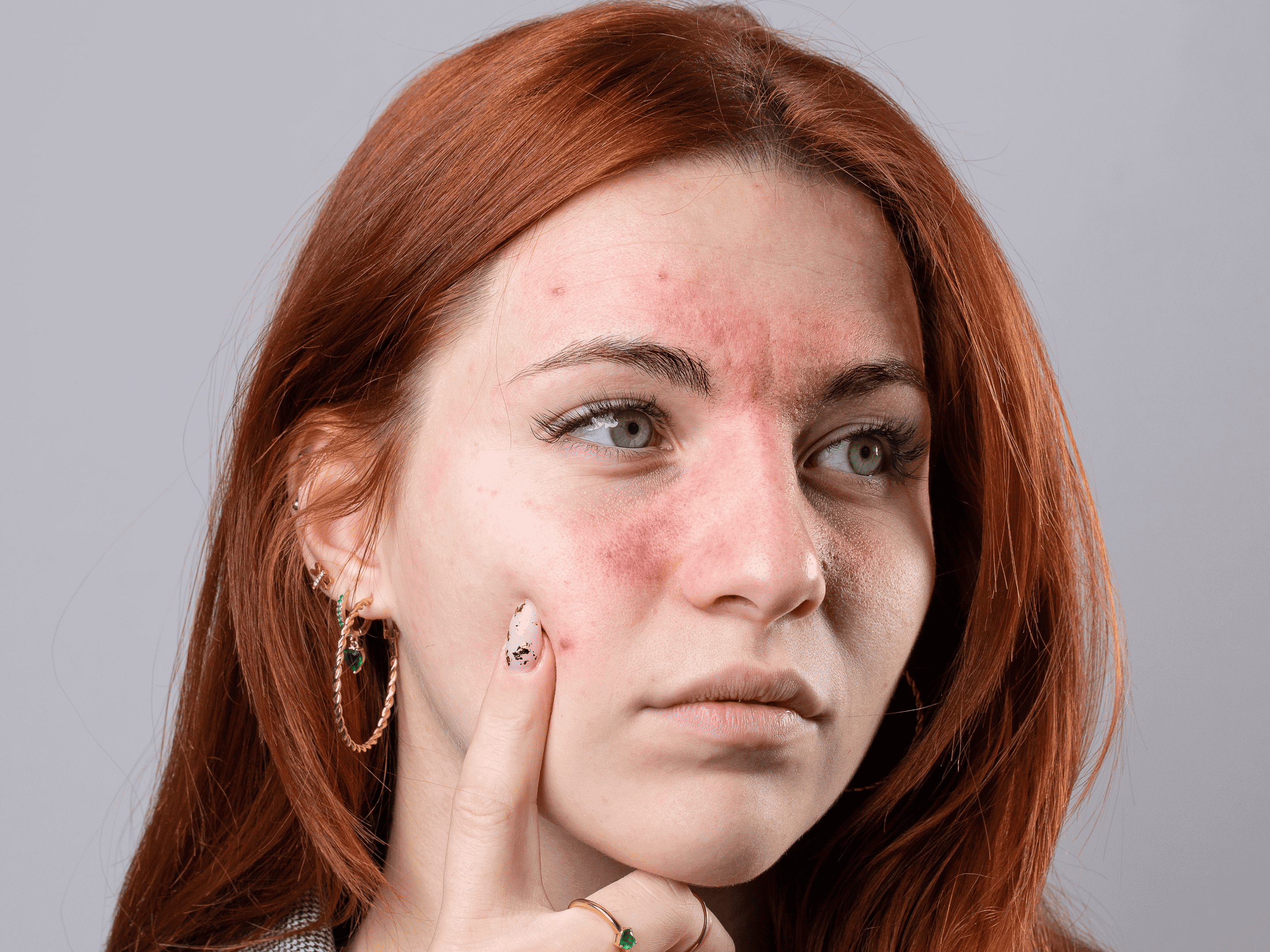 Facial redness and rosacea treated at The One Clinic Leicester