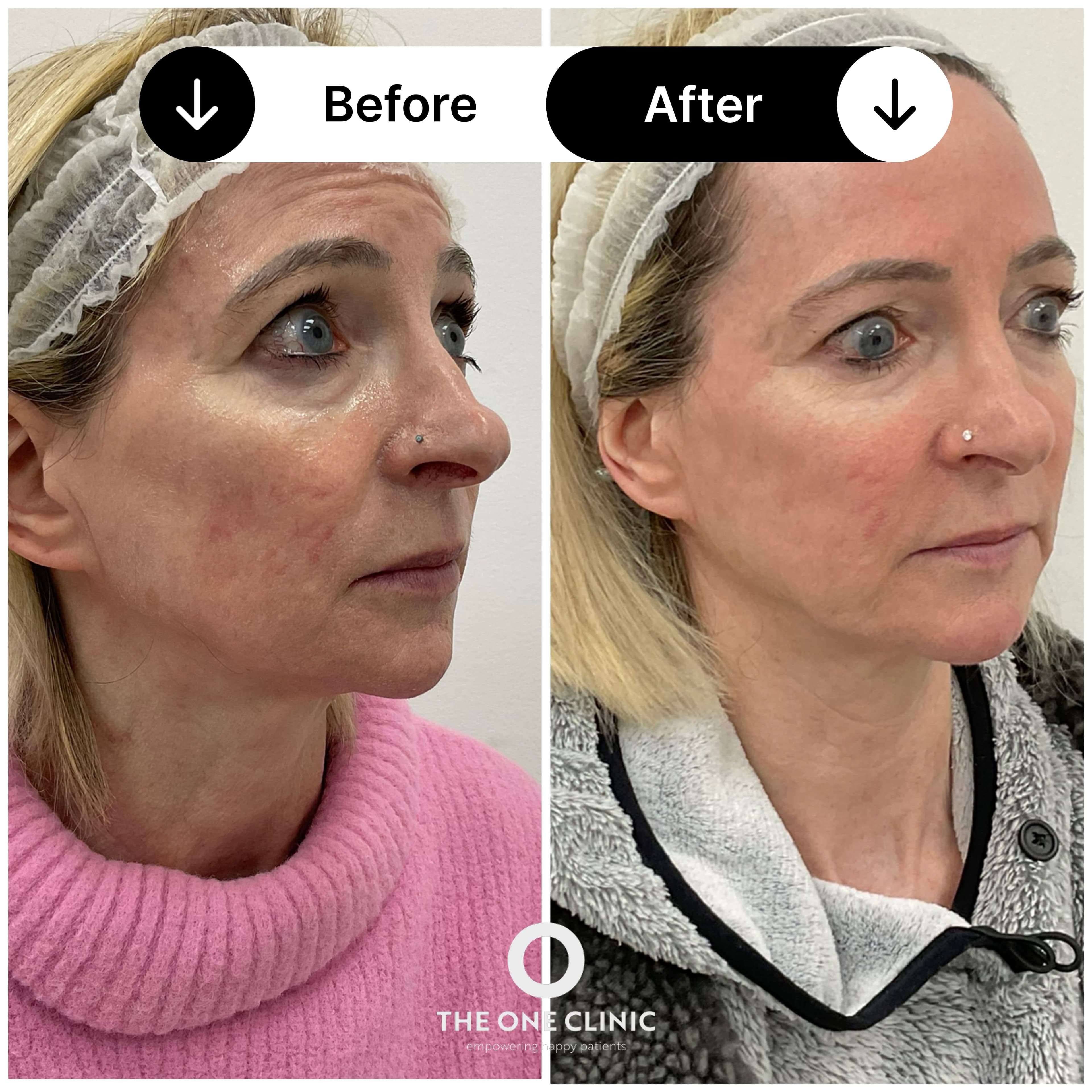 Dermal filler before and after result at The One Clinic Leicester