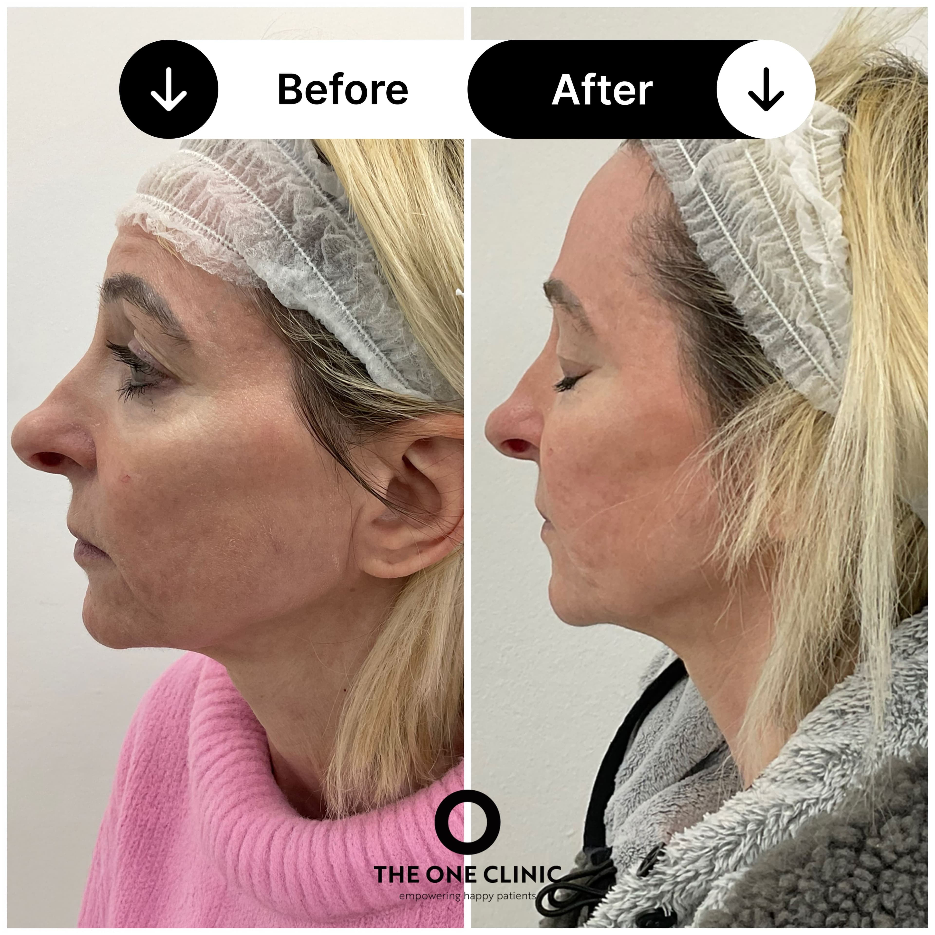 Dermal filler before and after result at The One Clinic Leicester