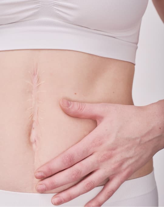 Cool Scar Lift treatment in progress at The One Clinic Leicester
