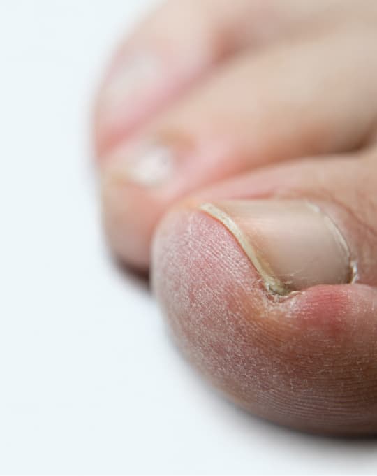 Ingrown toenail removal procedure at The One Clinic Leicester