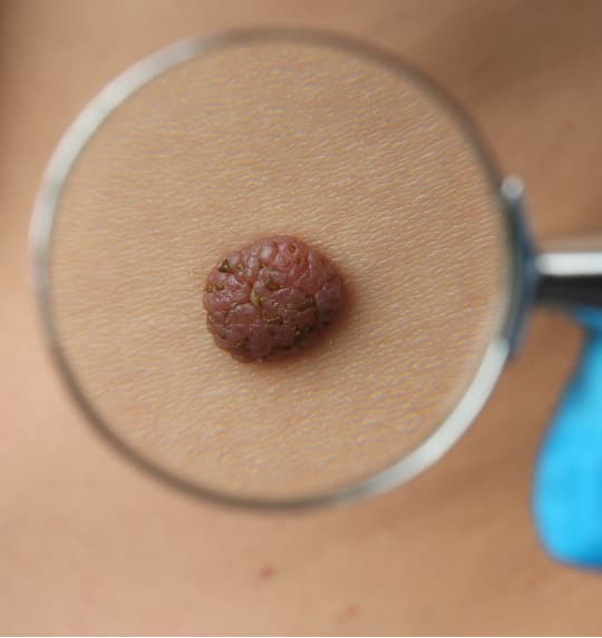 Skin tags removal treatment in progress at The One Clinic