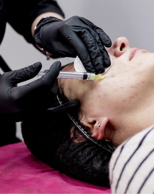Vampire Facial PRP treatment at The One Clinic Leicester