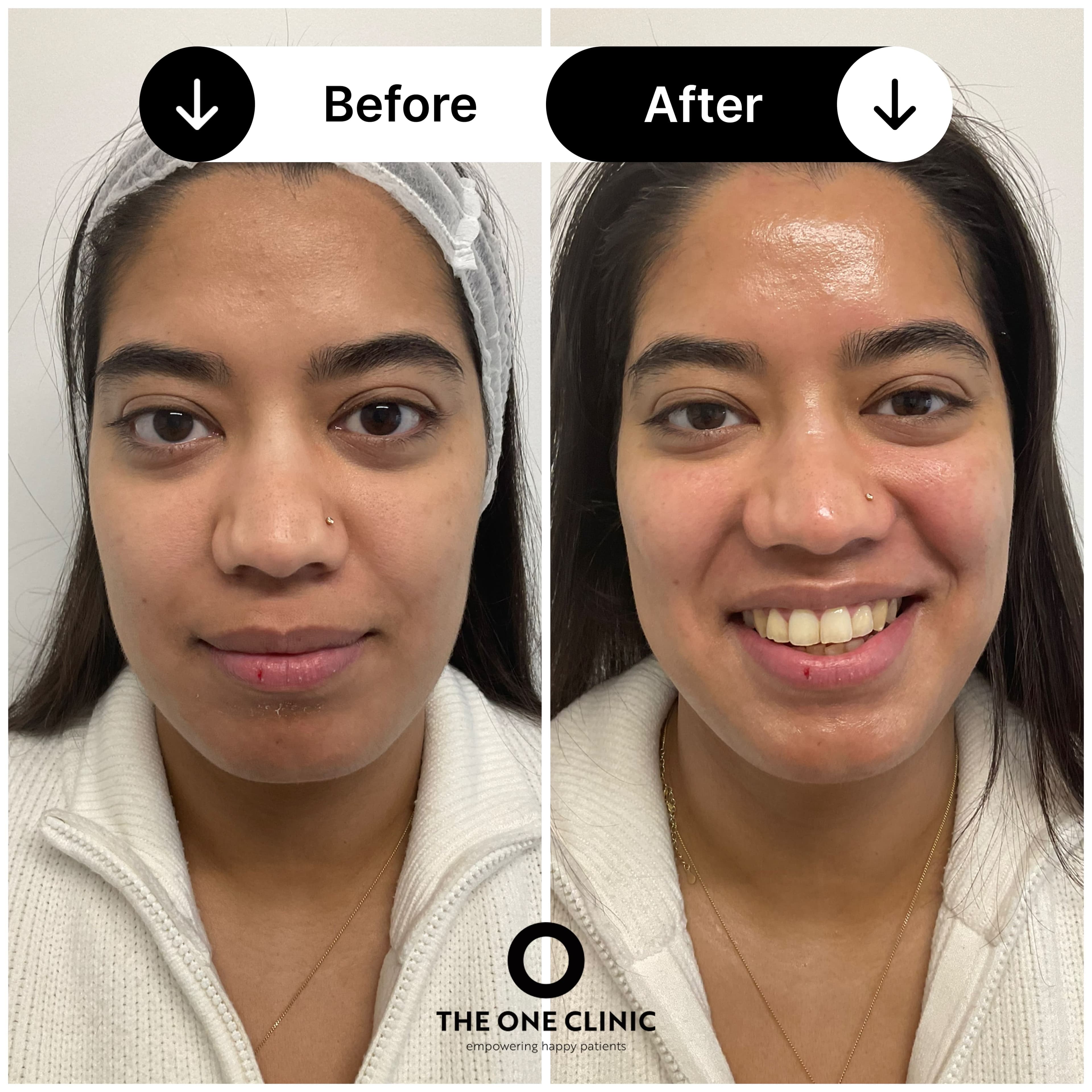 HydraFacial before and after result at The One Clinic Leicester
