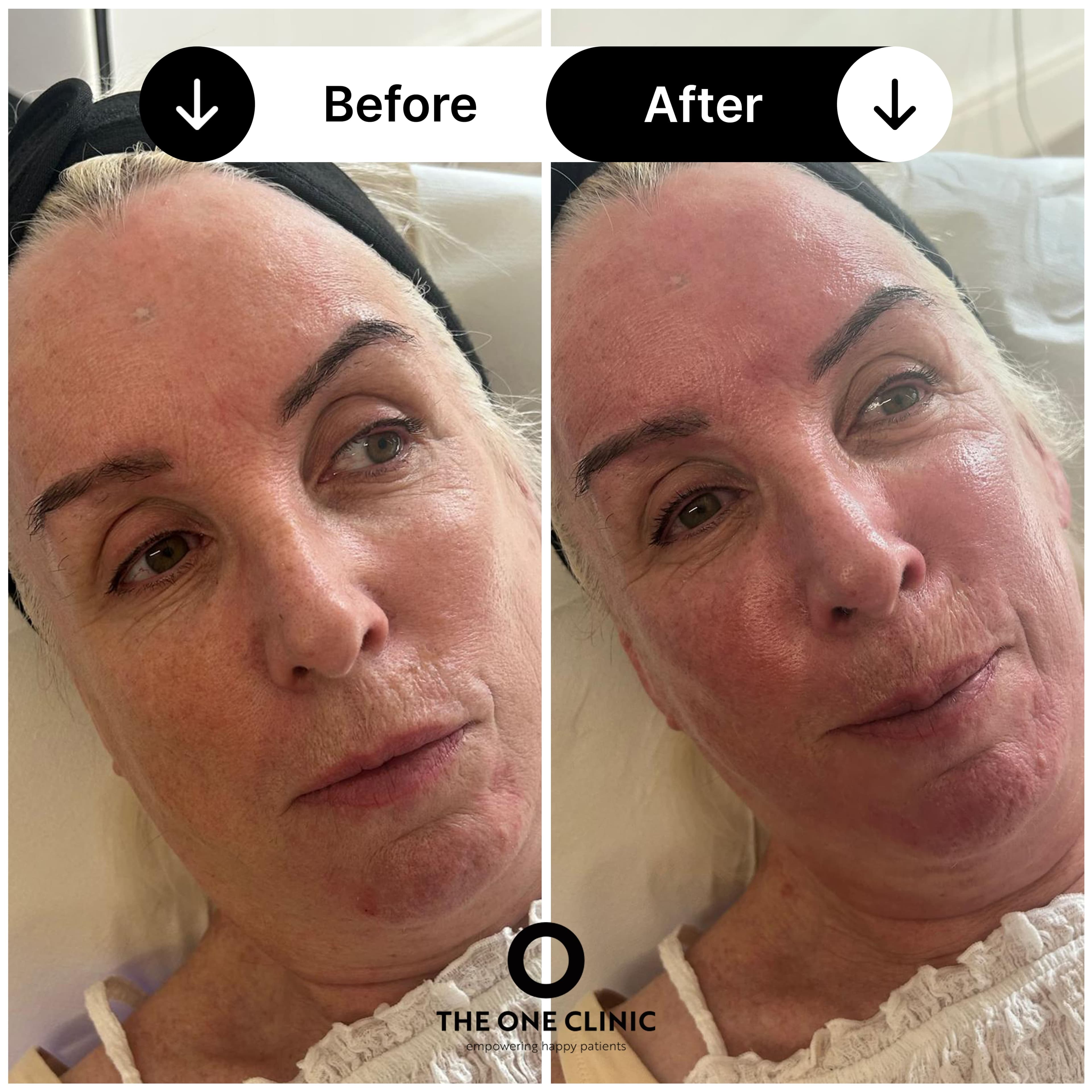 HydraFacial before and after result at The One Clinic Leicester