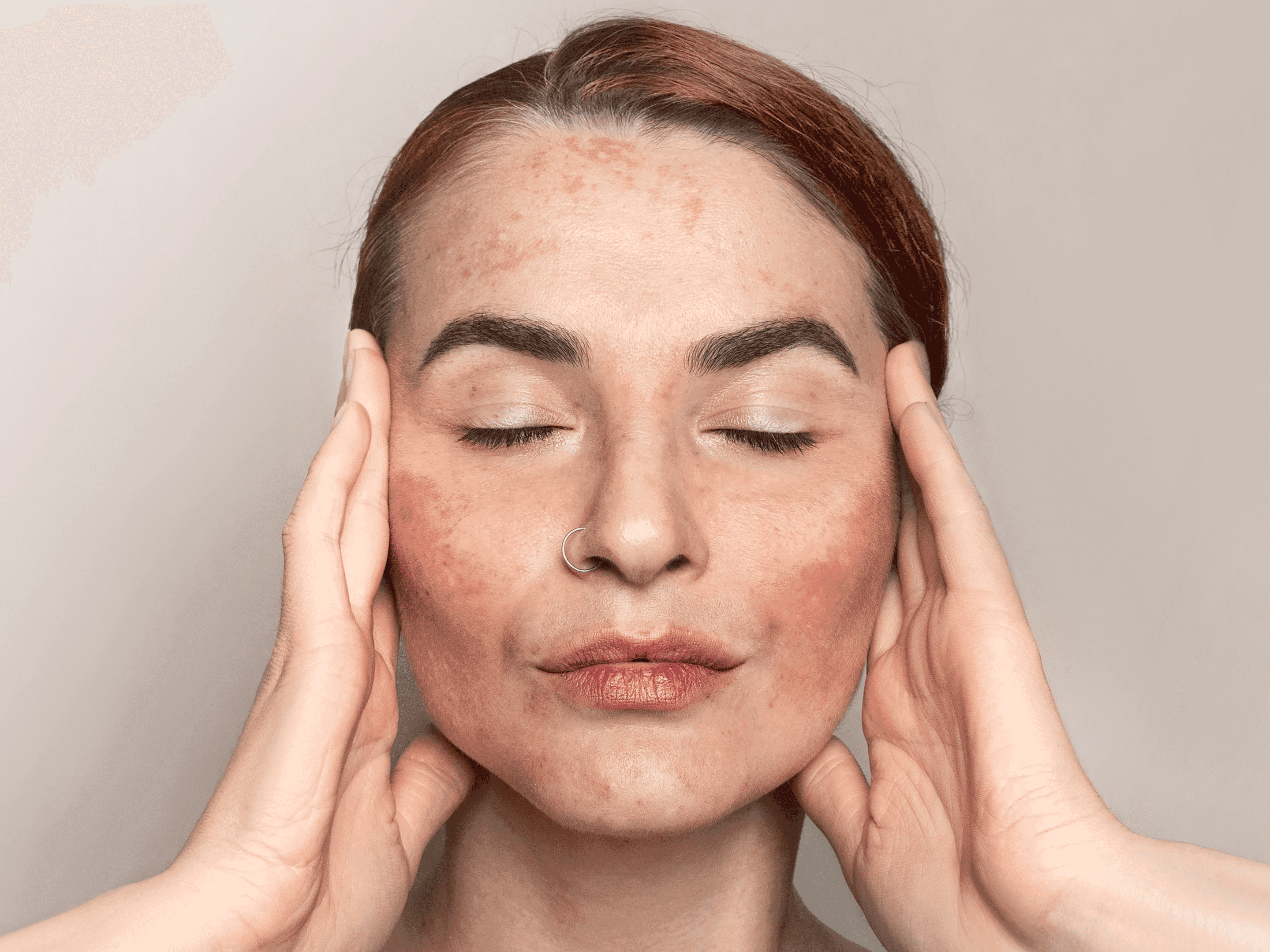 Hyperpigmentation and sun damage treatment at The One Clinic Leicester
