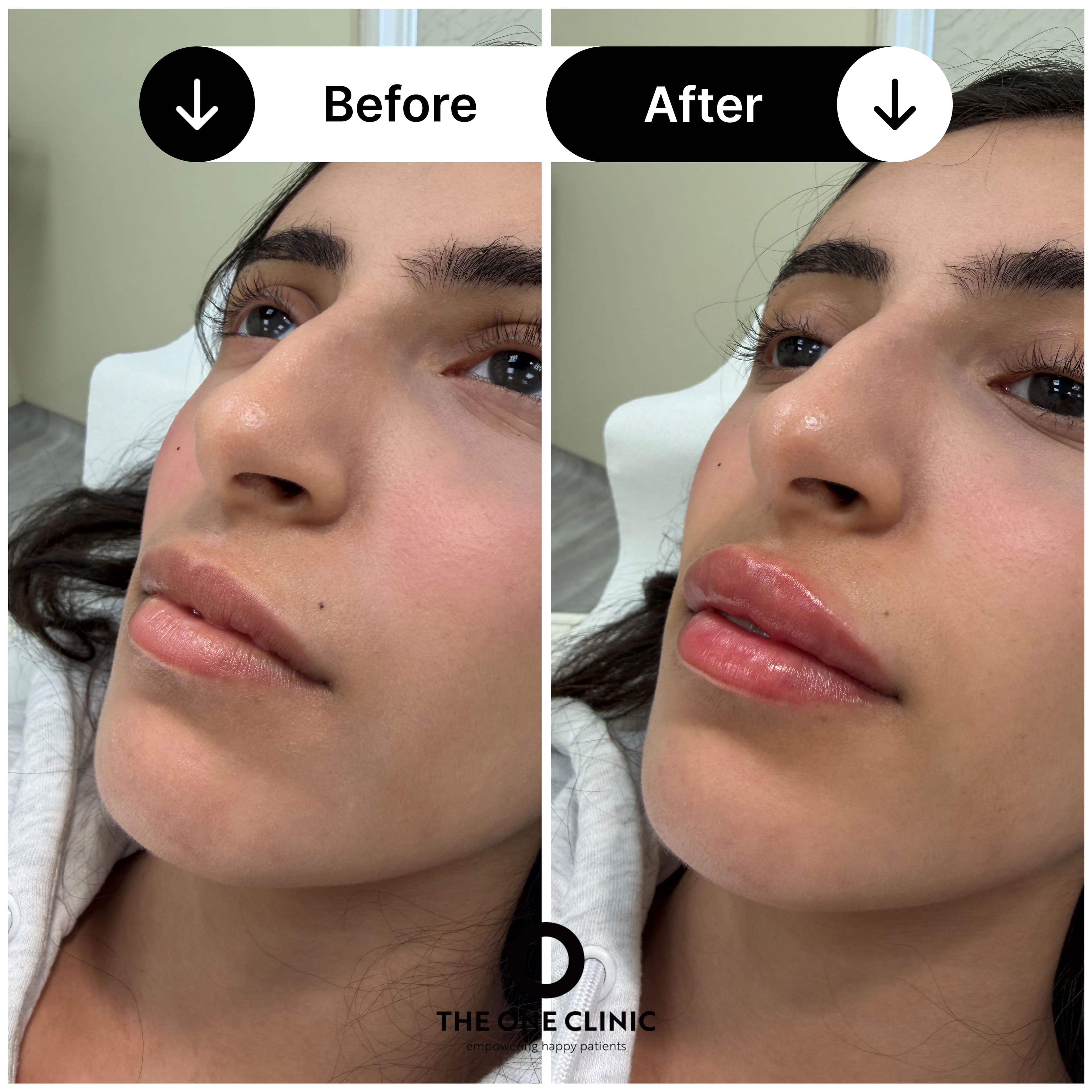 Lip filler before and after result at The One Clinic Leicester