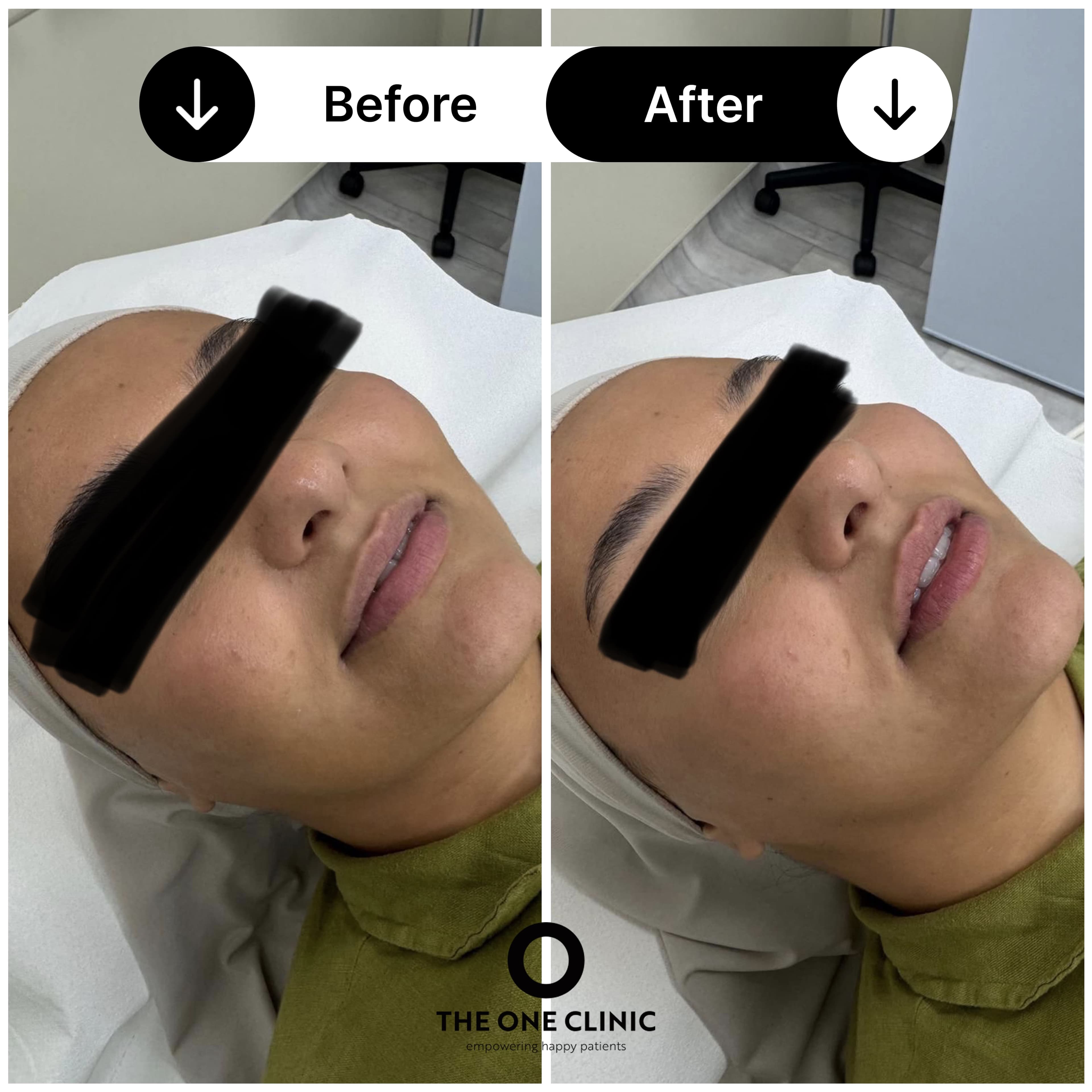 Lip filler before and after result at The One Clinic Leicester