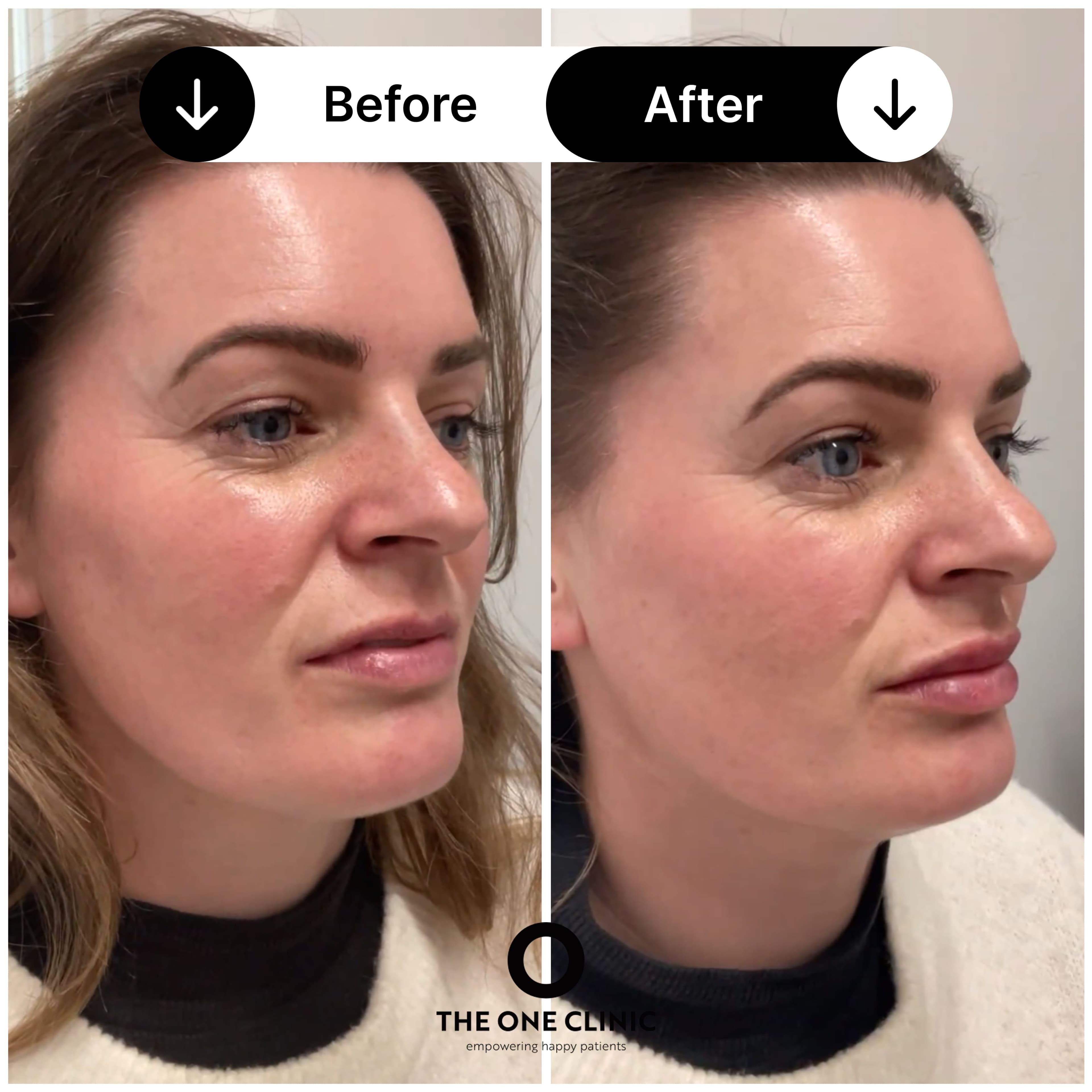 Lip filler before and after result at The One Clinic Leicester