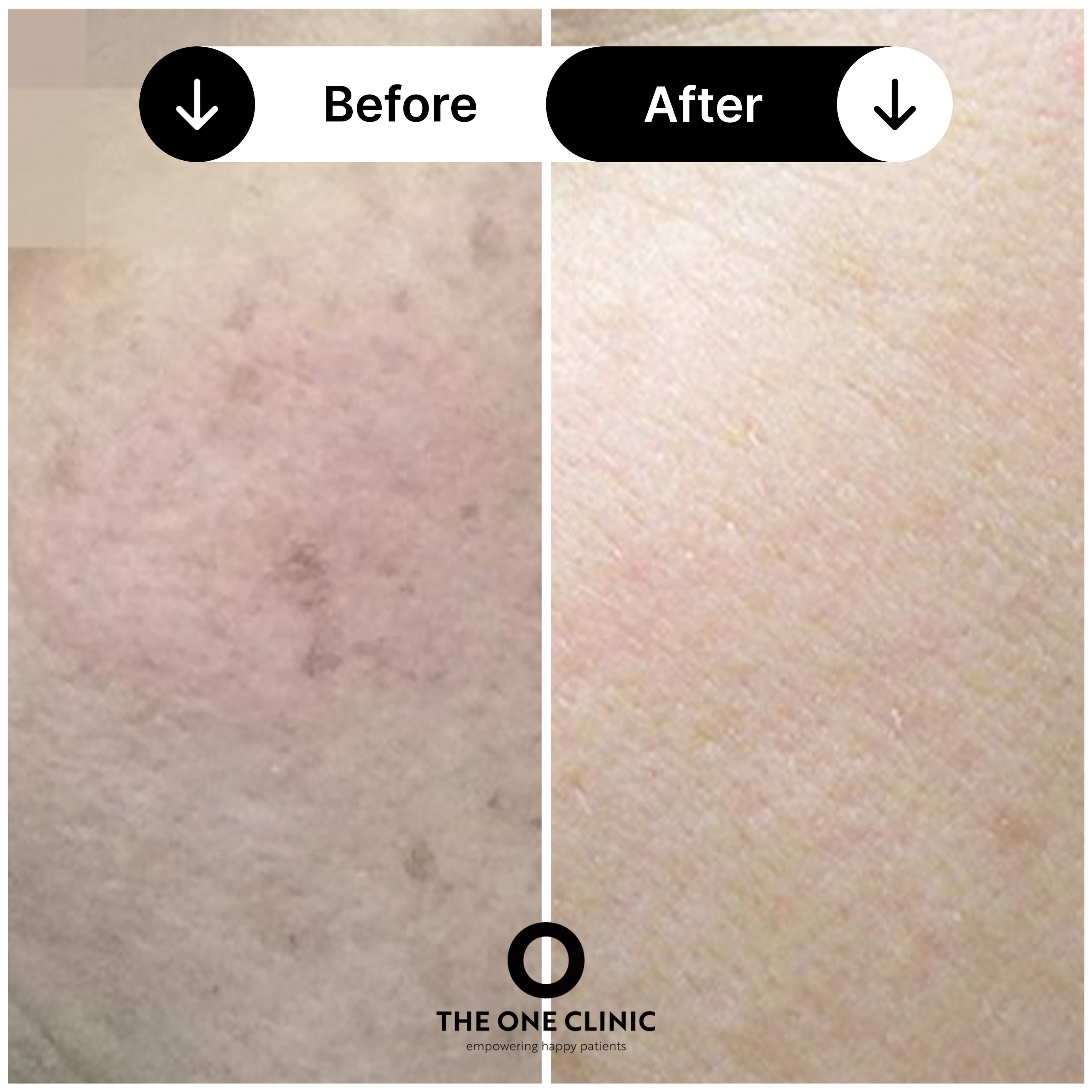 Lumecca IPL before and after result at The One Clinic Leicester
