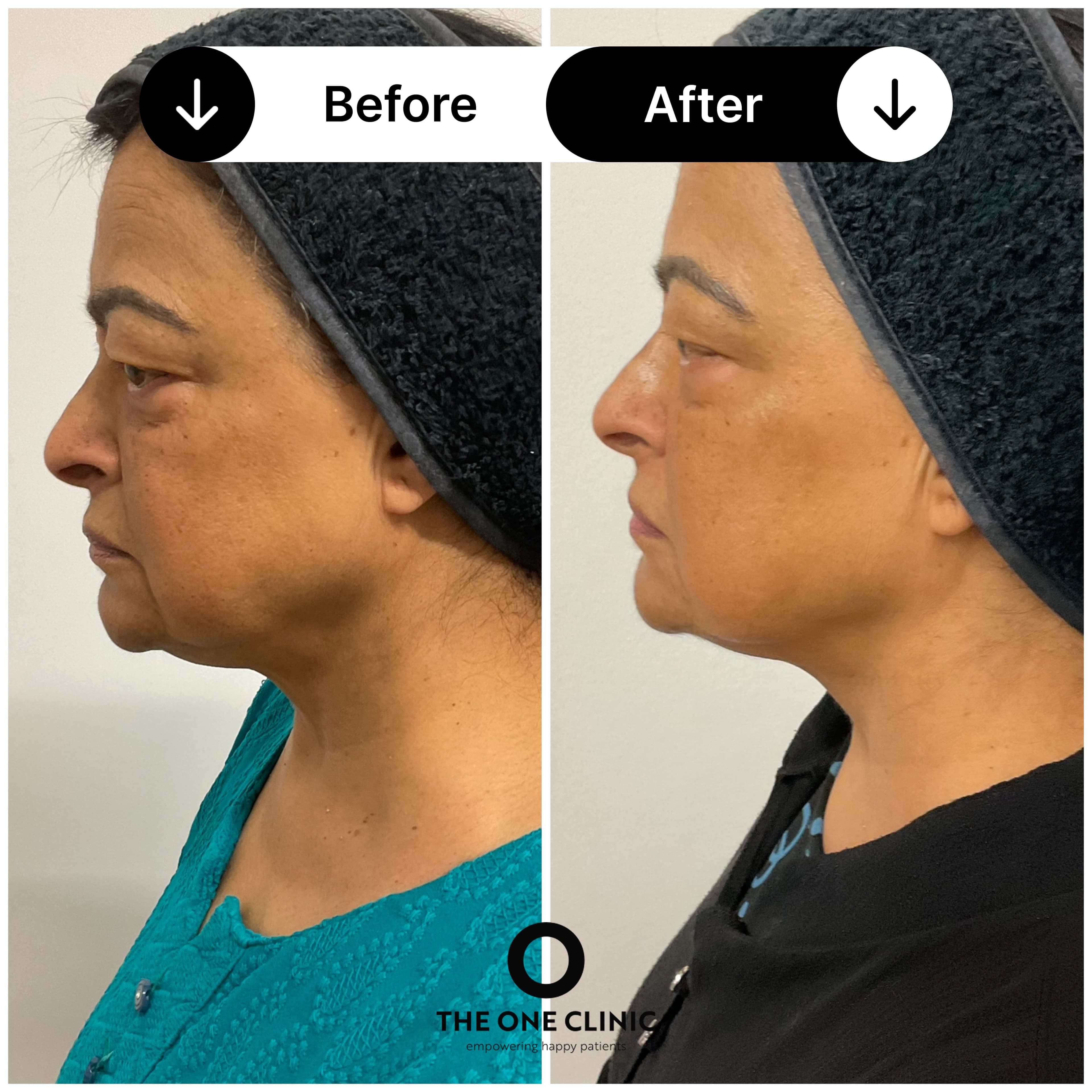Morpheus 8 before and after results