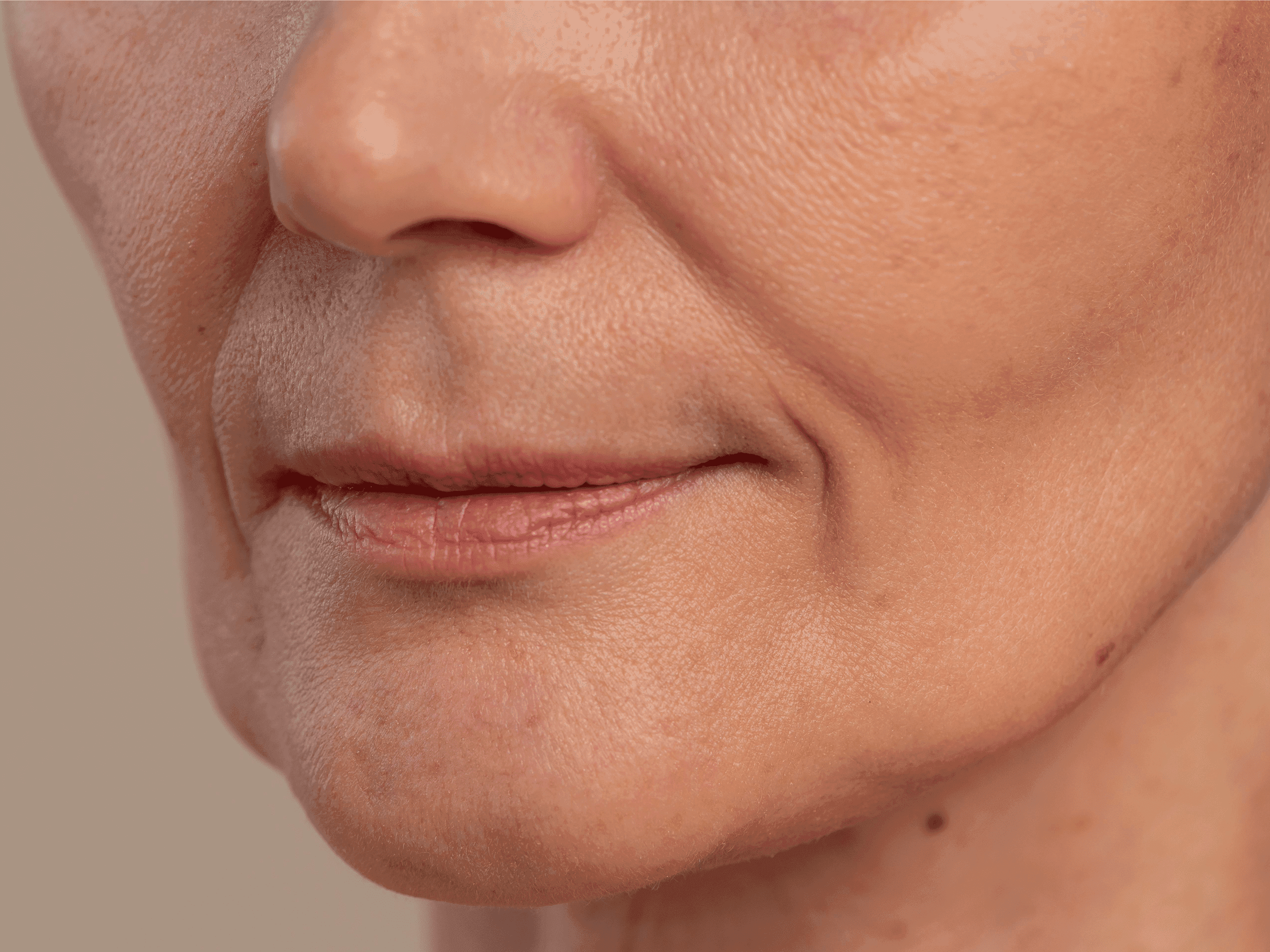 Close-up showing nasolabial folds (smile lines) treated at The One Clinic Leicester