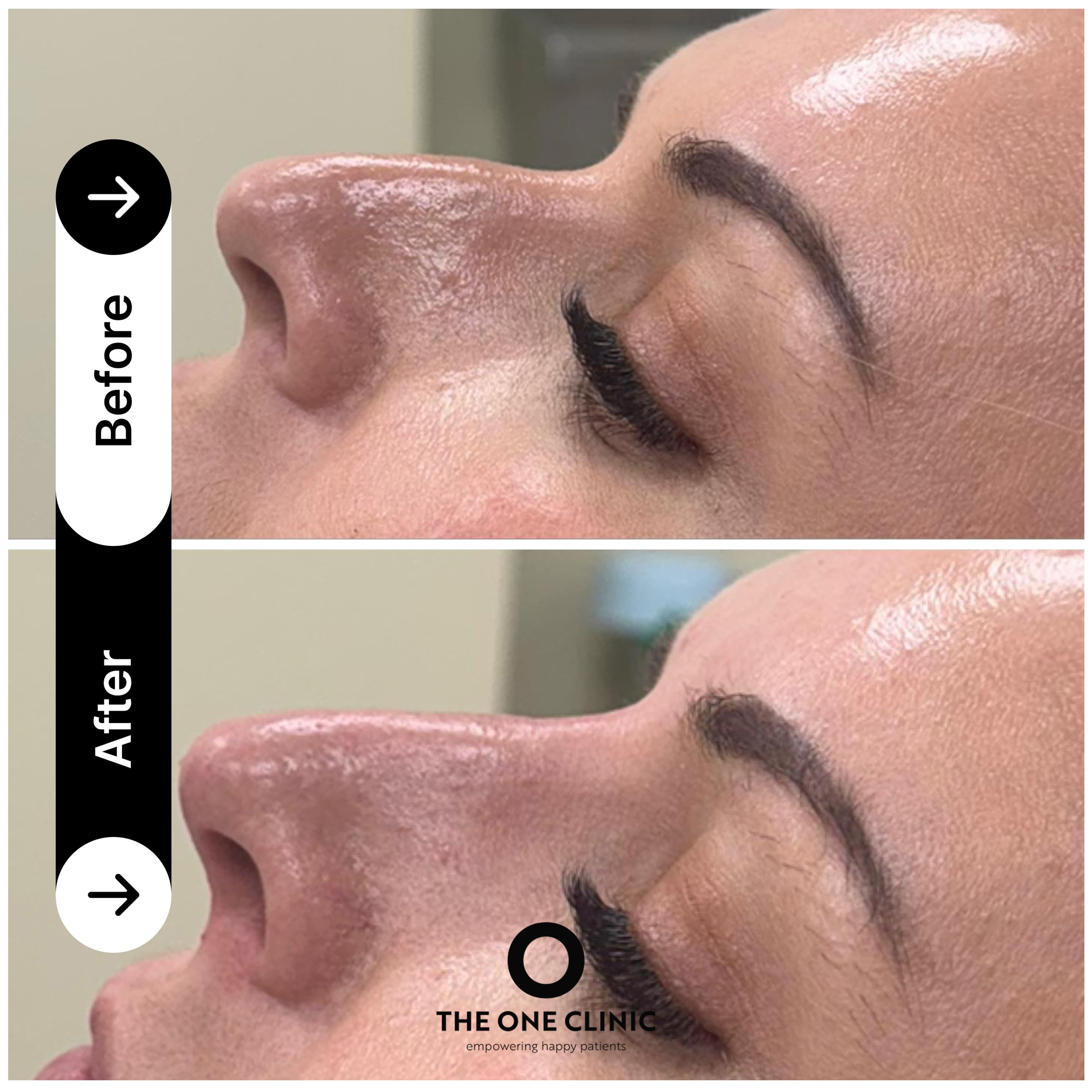 Non-surgical rhinoplasty before and after result at The One Clinic Leicester