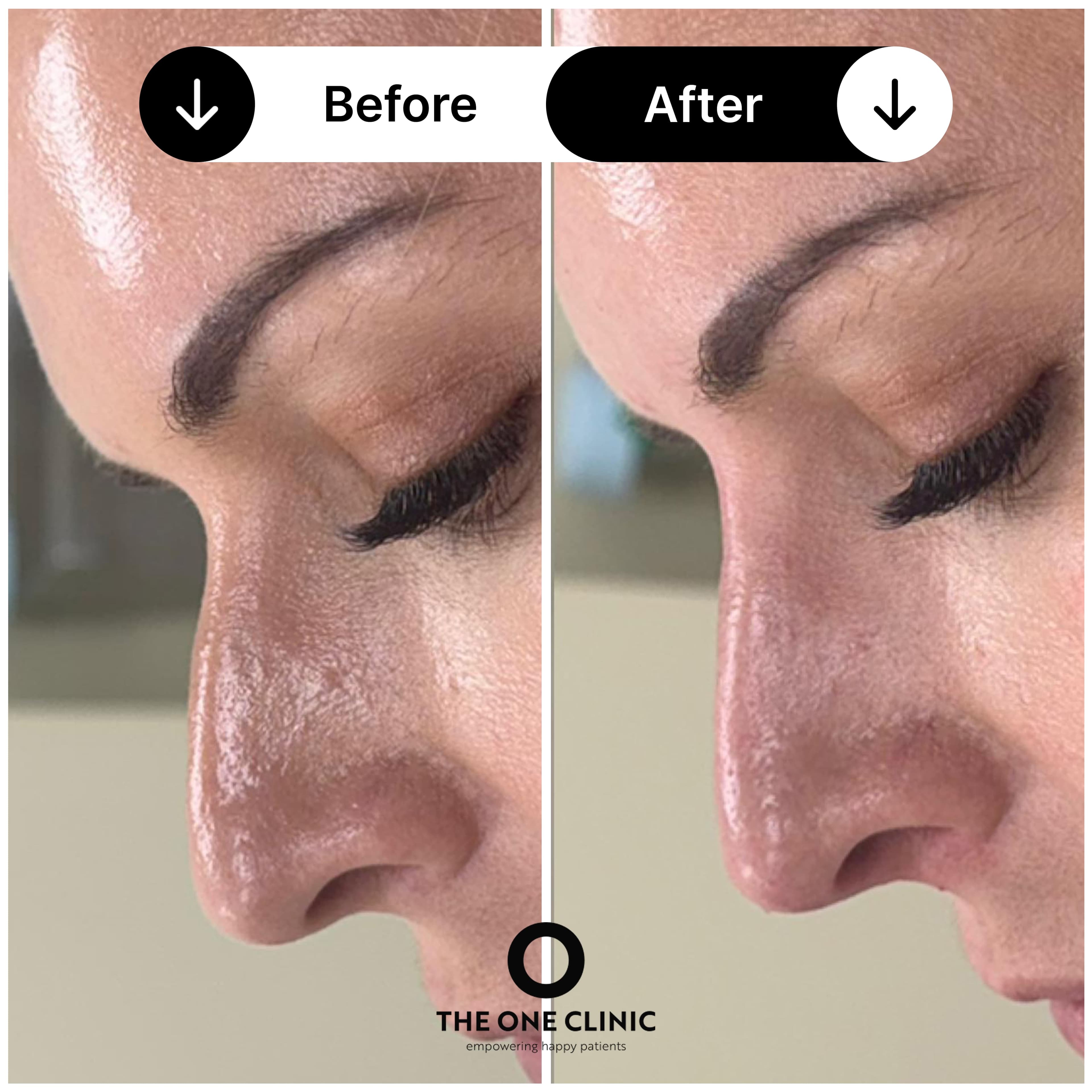 Non-surgical rhinoplasty before and after result at The One Clinic Leicester