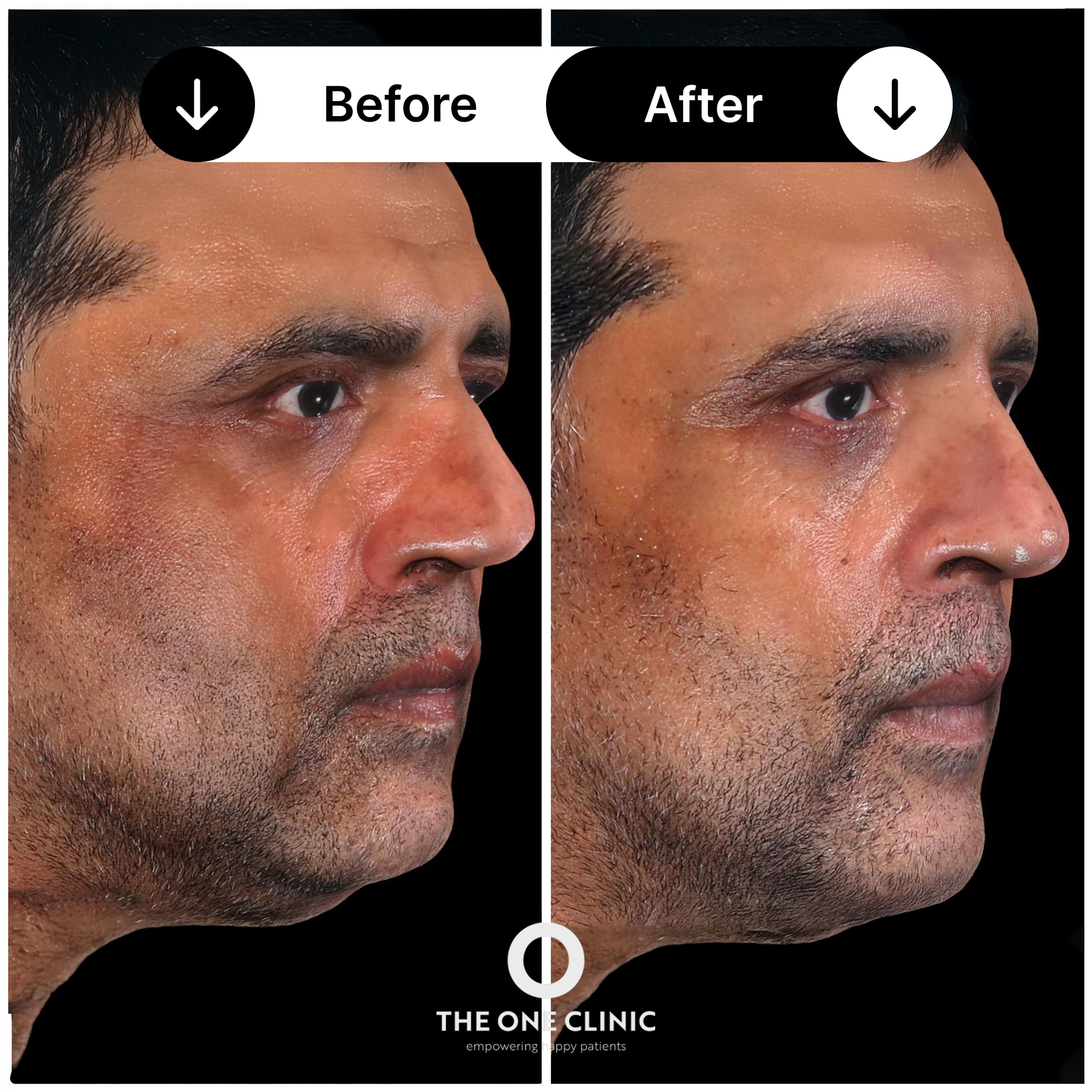 Pigmentation treatment before and after