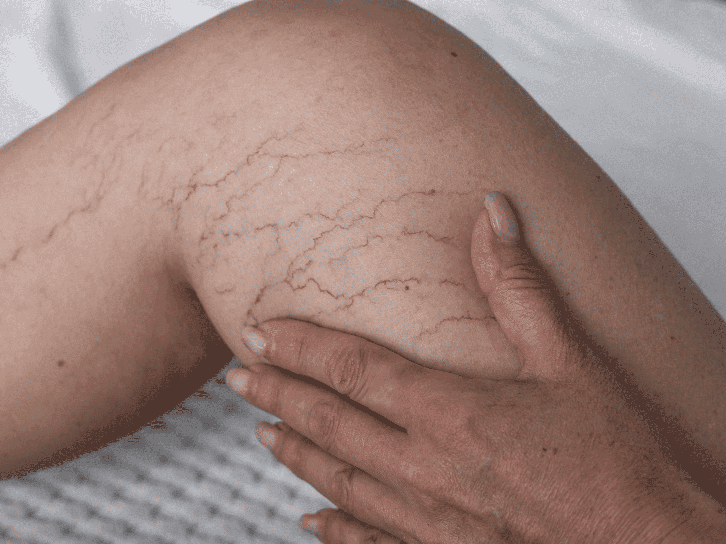Spider veins and thread veins treatment at The One Clinic Leicester