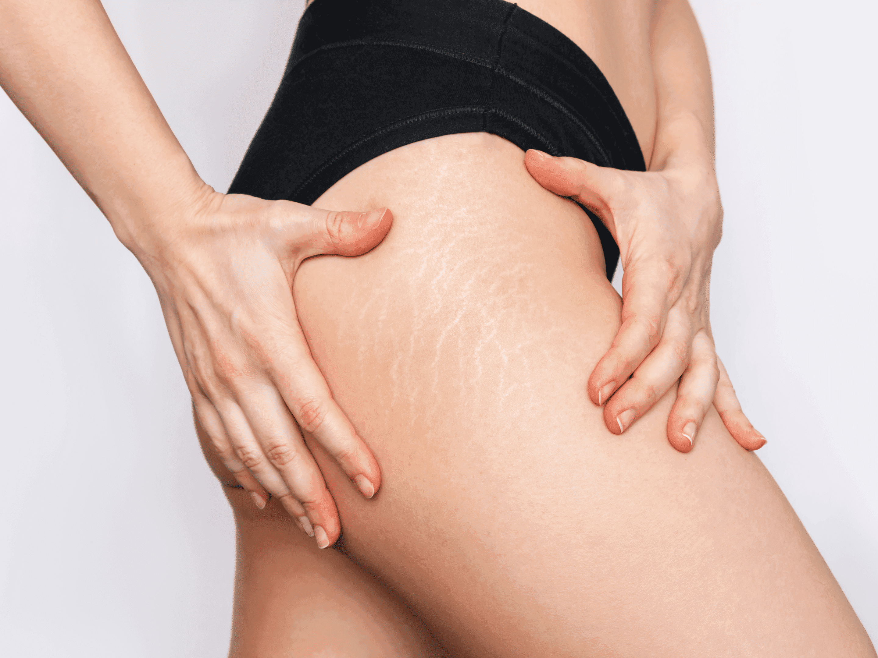 Stretch marks treatment at The One Clinic Leicester