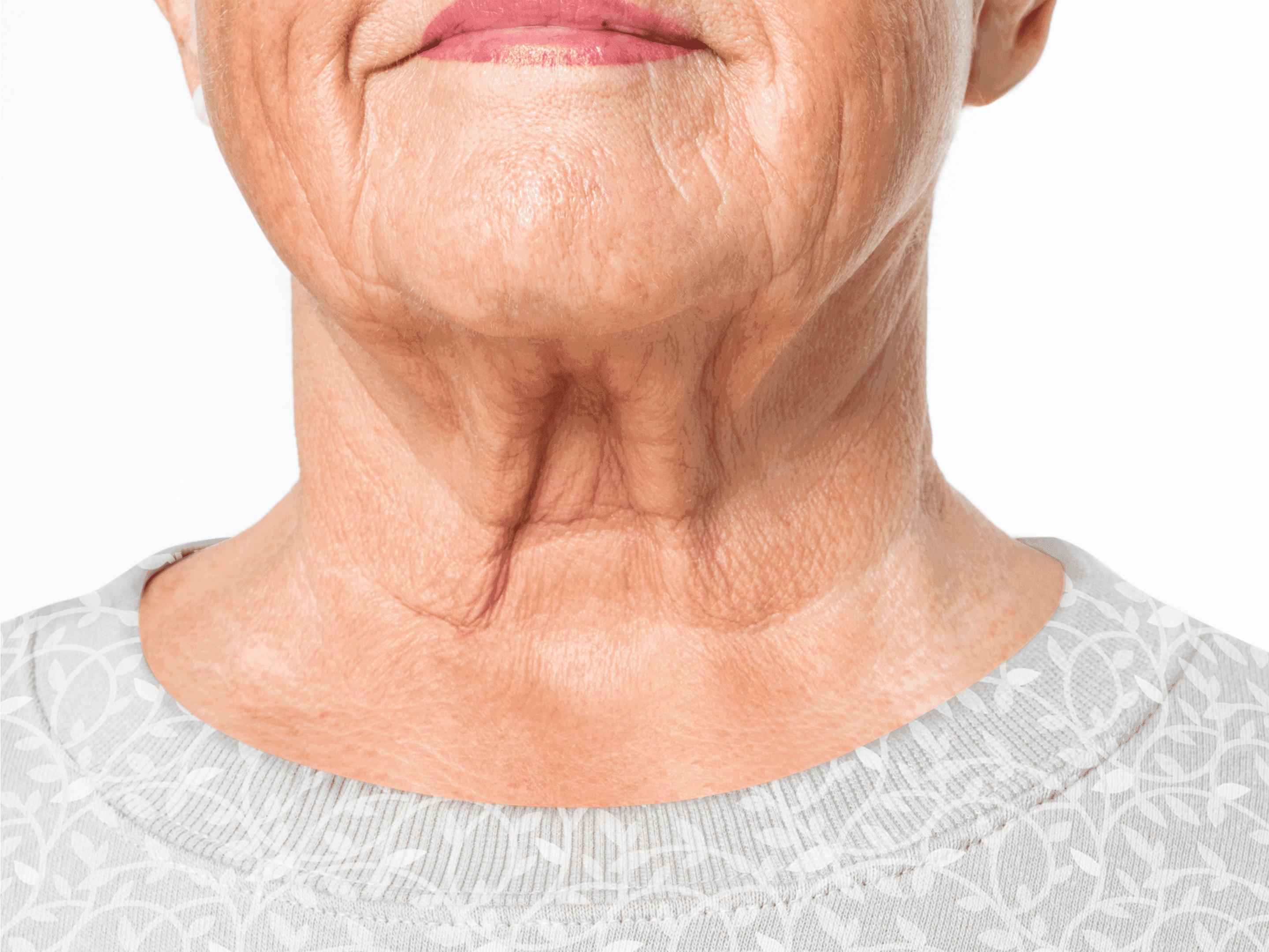 Neck area showing turkey neck and necklines, treated at The One Clinic Leicester