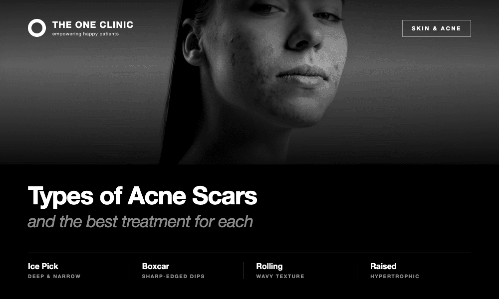 Types of Acne Scars and the Best Treatment for Each