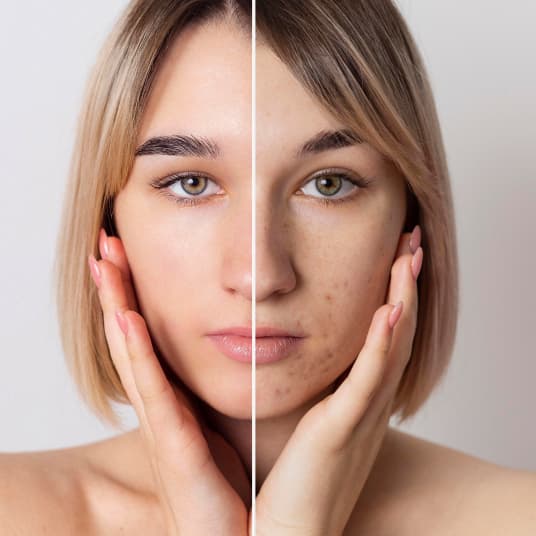 Vampire Facial consultation at The One Clinic